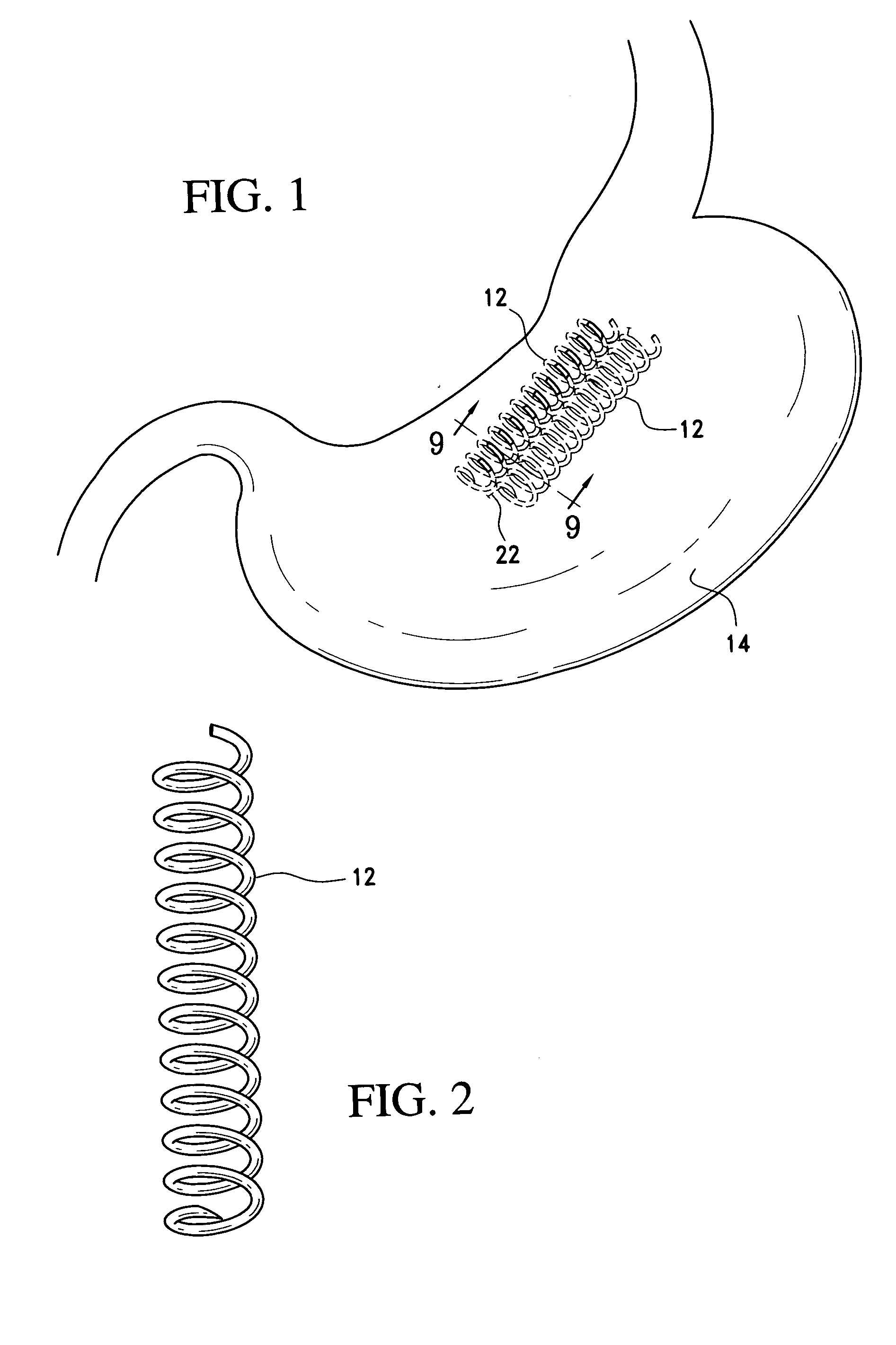 Single pass gastric restriction with a corkscrew style wall anchor