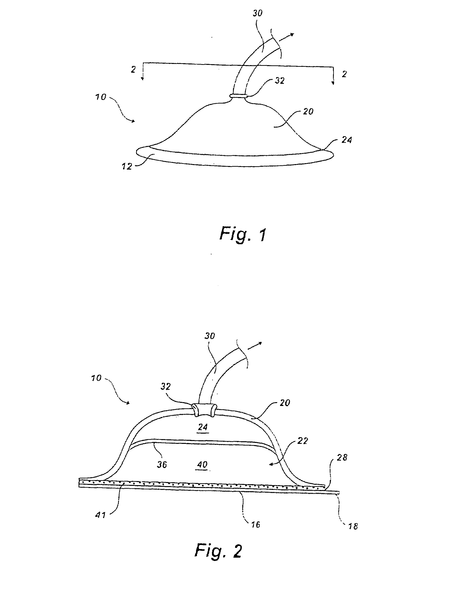 Device and method for wound therapy