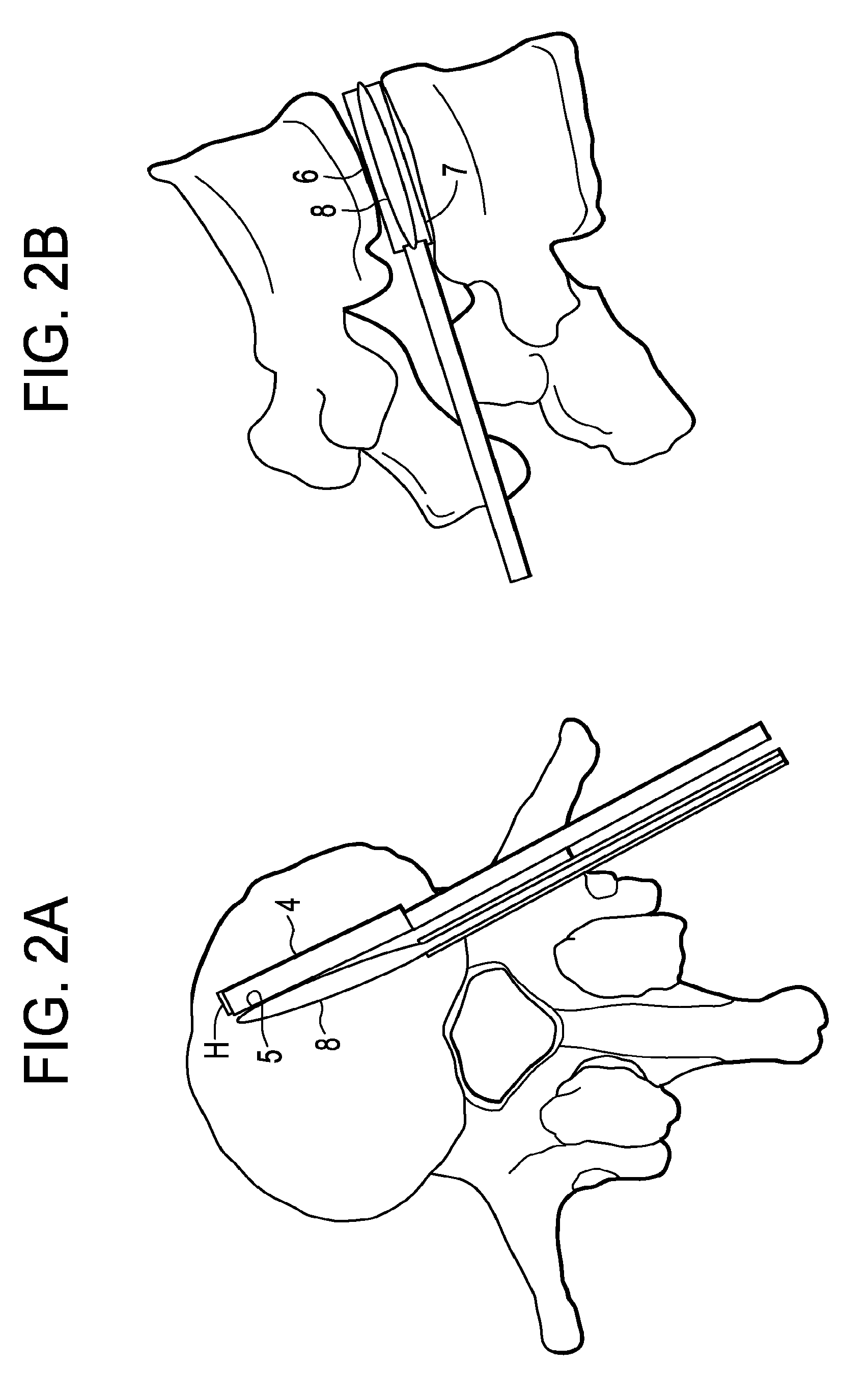 Balloon With Shape Control For Spinal Procedures