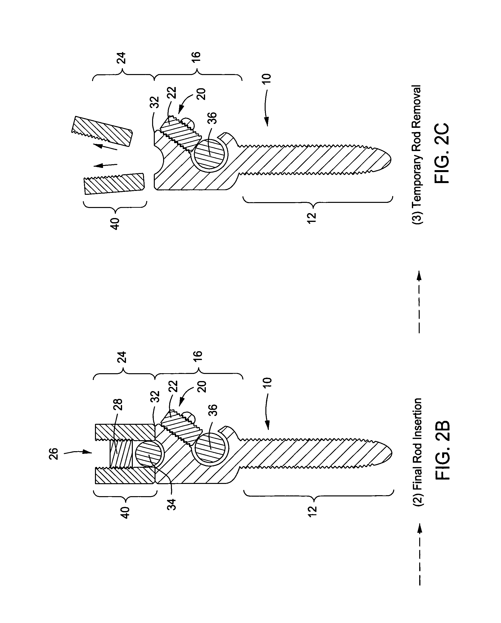 Pedicle screw