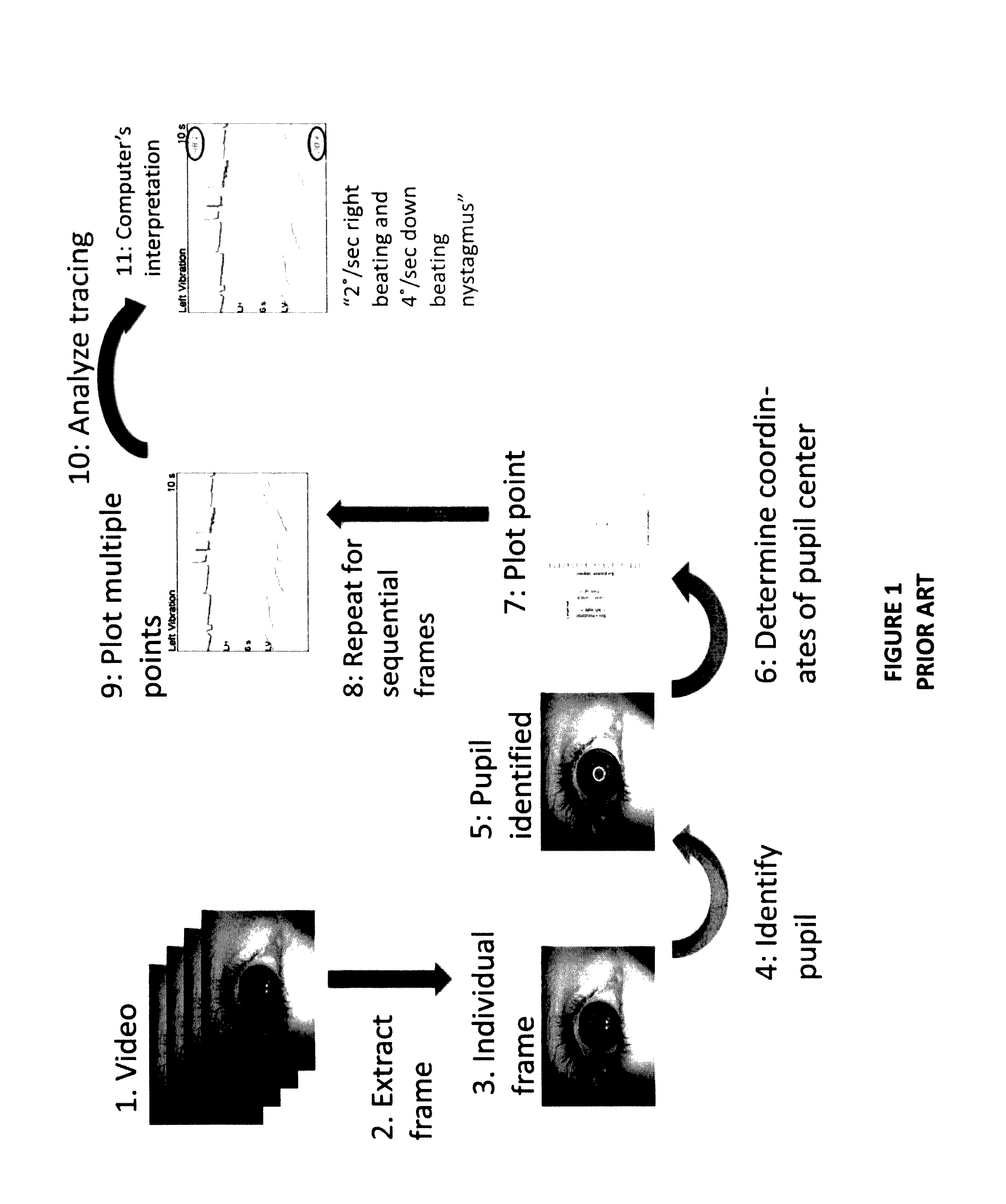 Filtering eye blink artifact from infrared videonystagmography