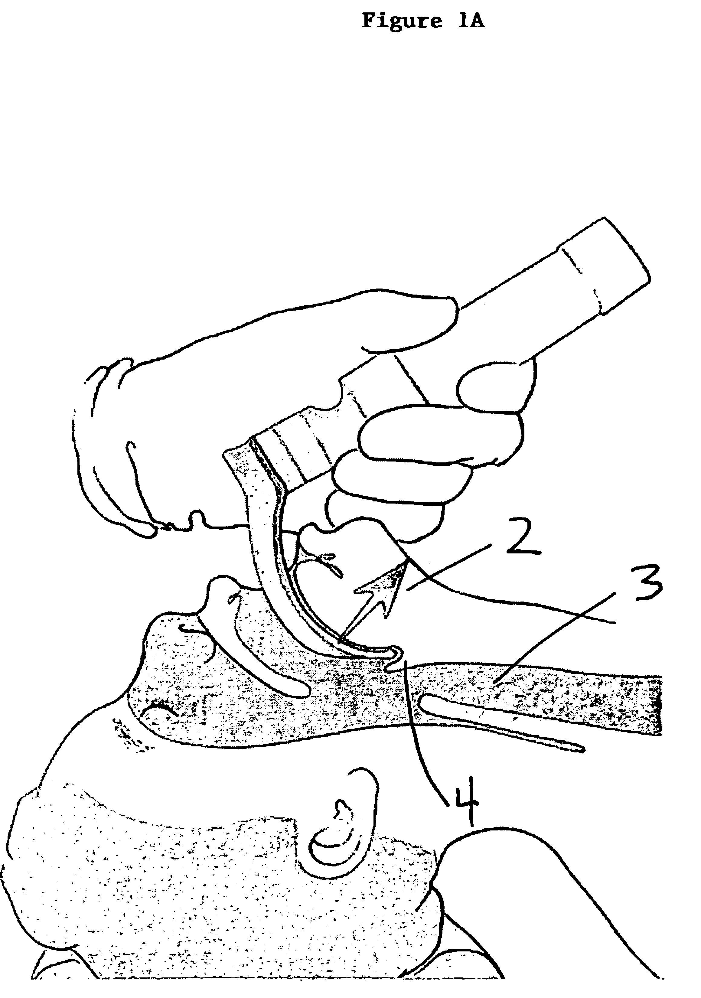 Apparatus for orotracheal intubation