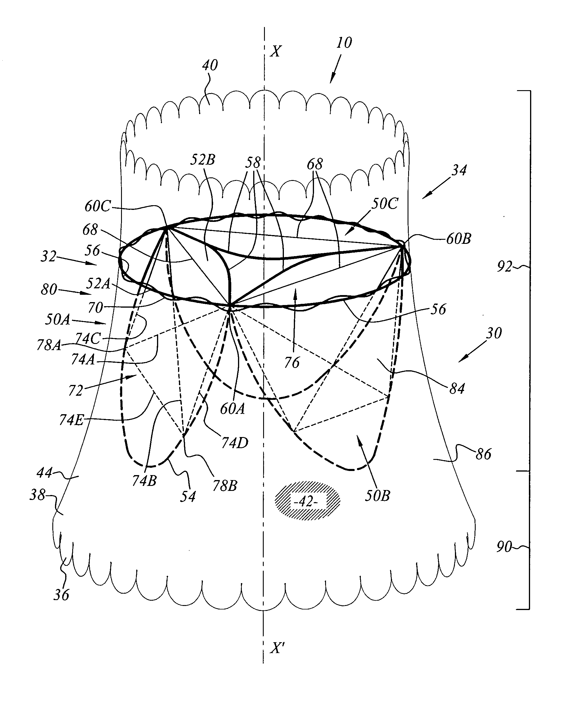 Implant for placing in a blood circulation conduit