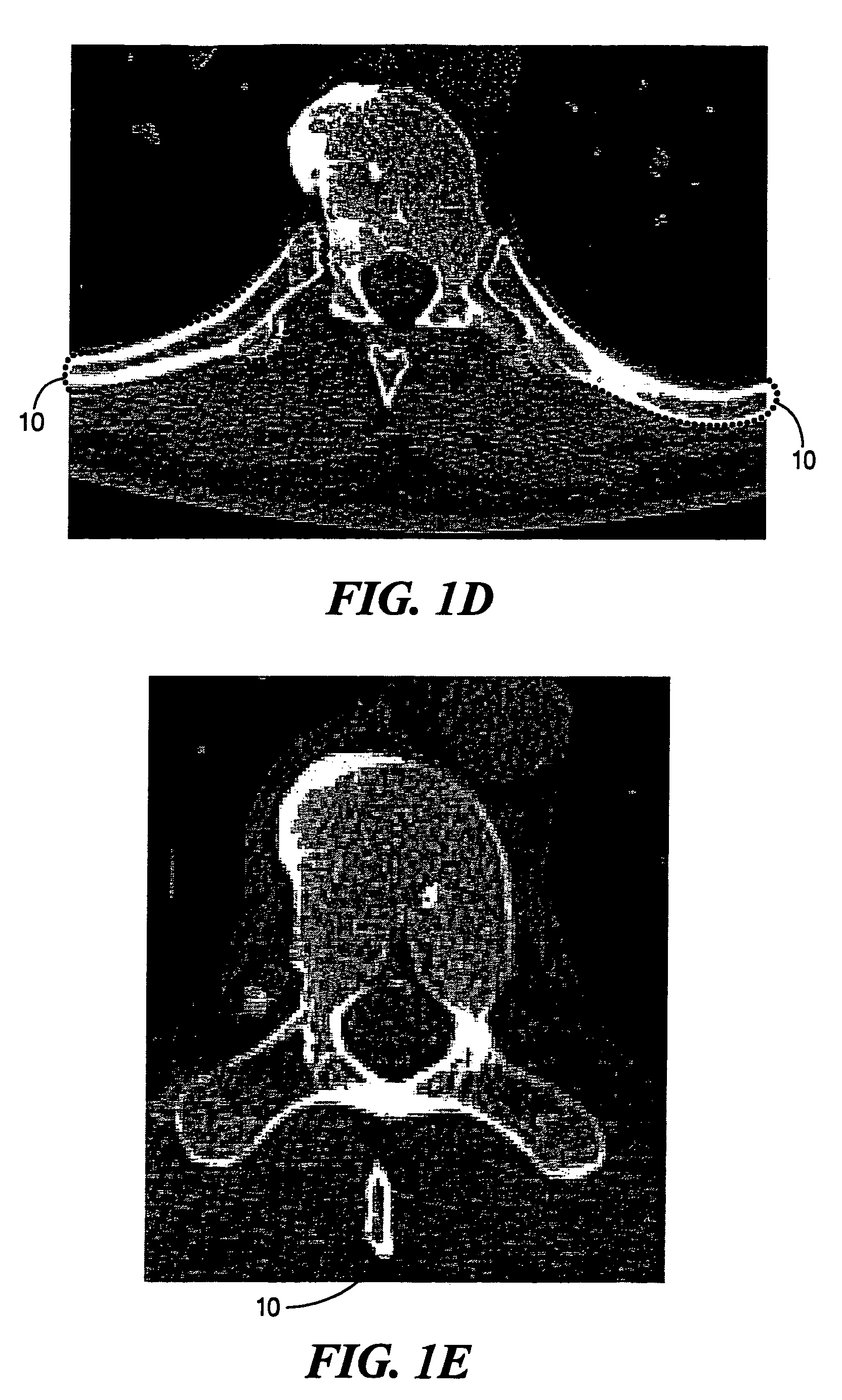 Method of incorporating prior knowledge in level set segmentation of 3D complex structures