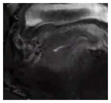 Cervical cancer MRI image segmentation device and method
