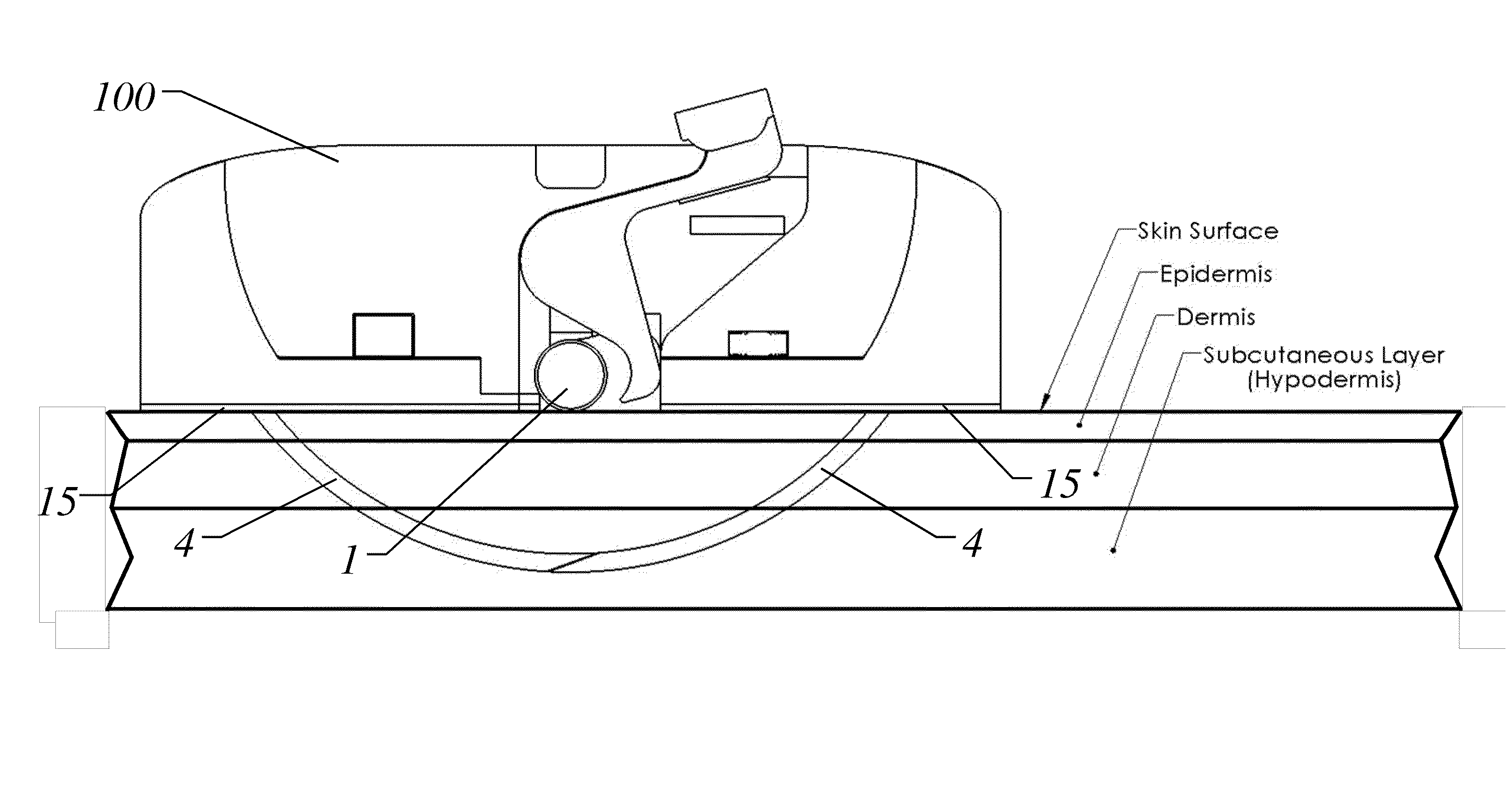 Catheter anchoring device and method