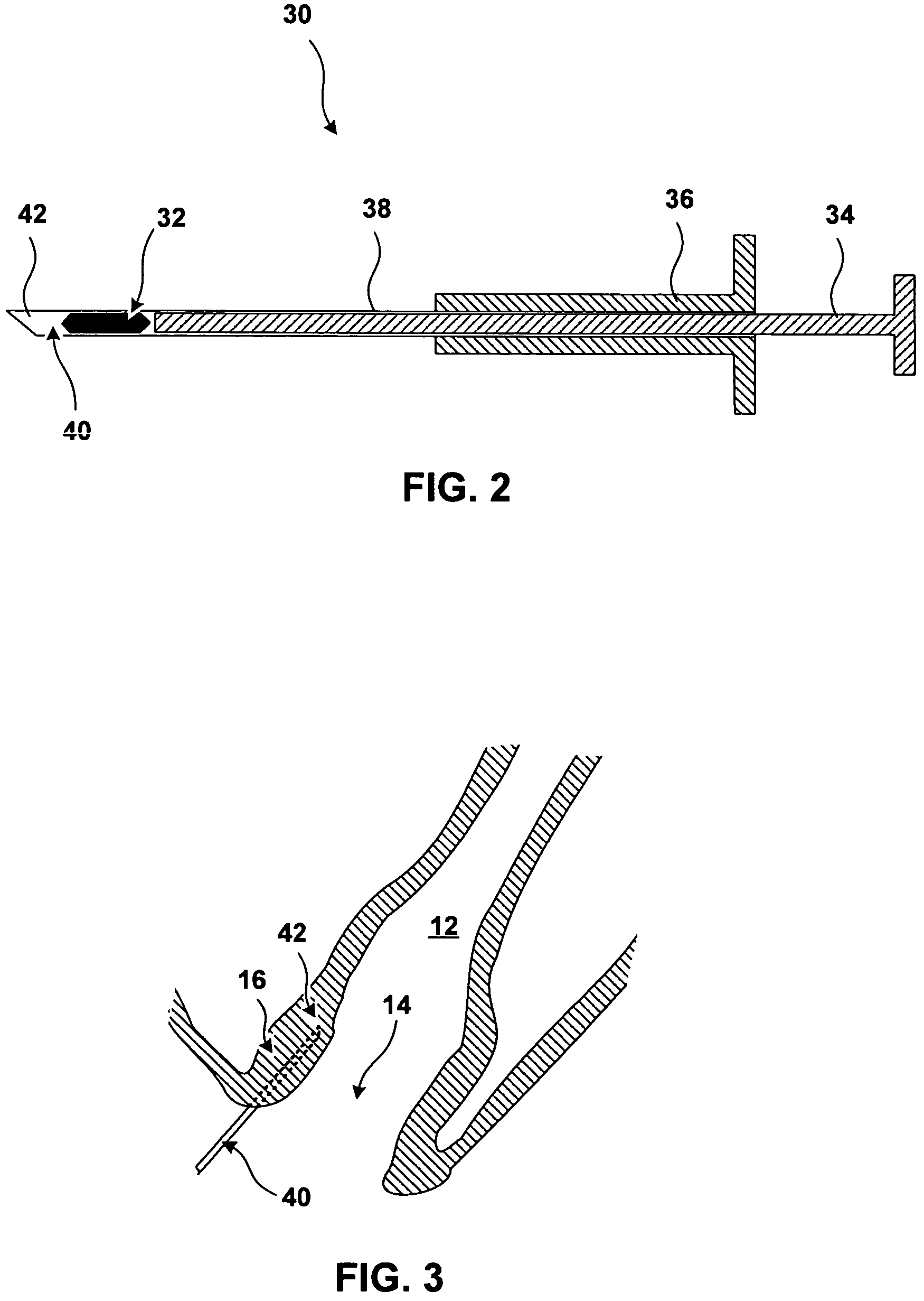 Implantable devices and methods for treating fecal incontinence