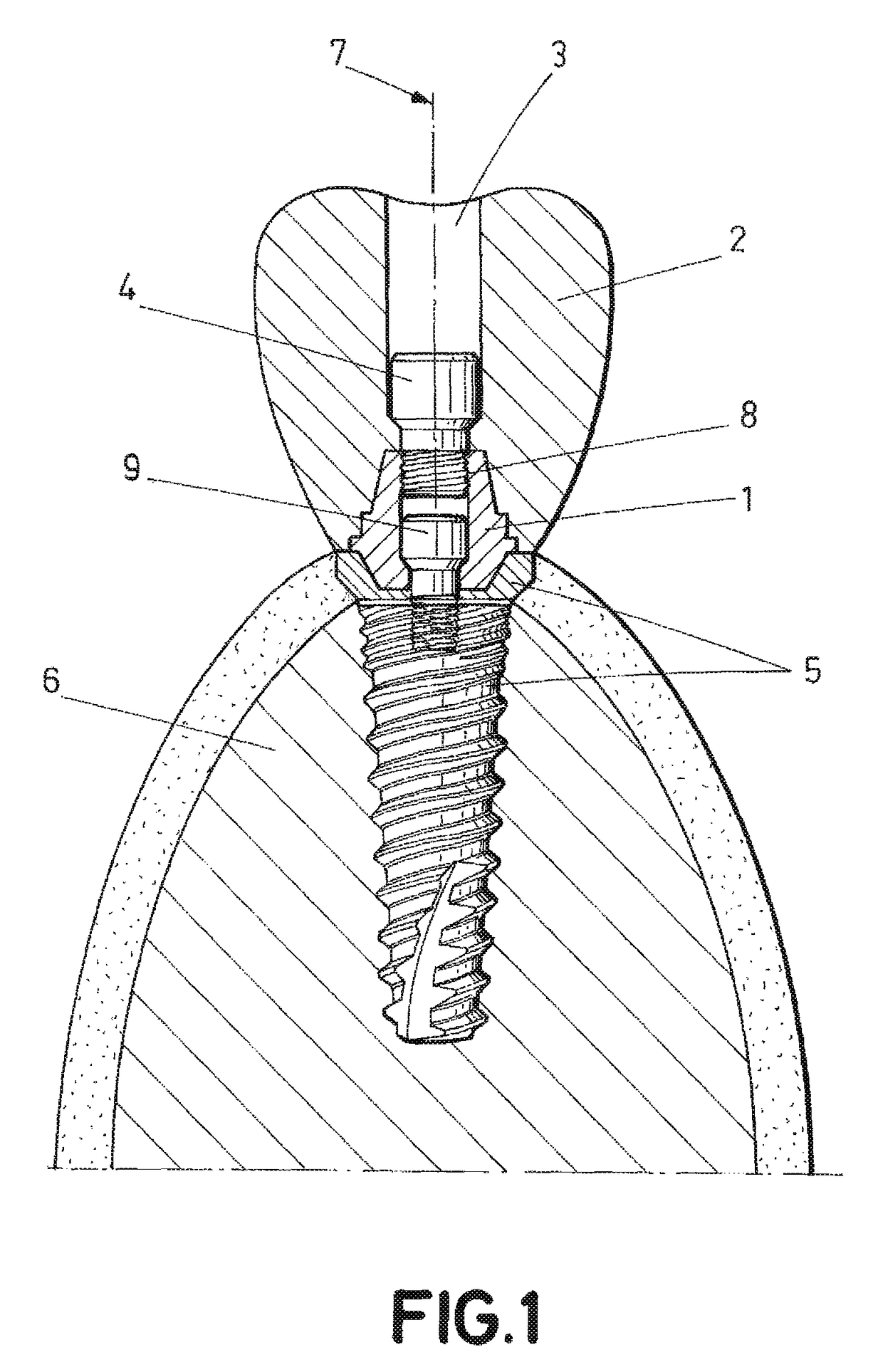 Dental post for supporting dental prostheses and method for the production thereof