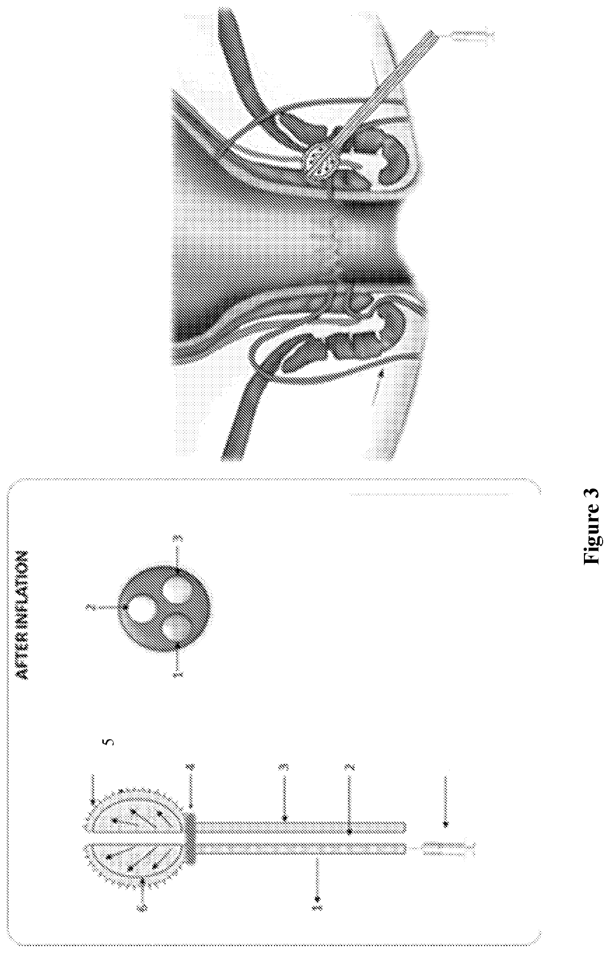A device for the treatment of anal fistula-in-ano and complex fistula-in-ano