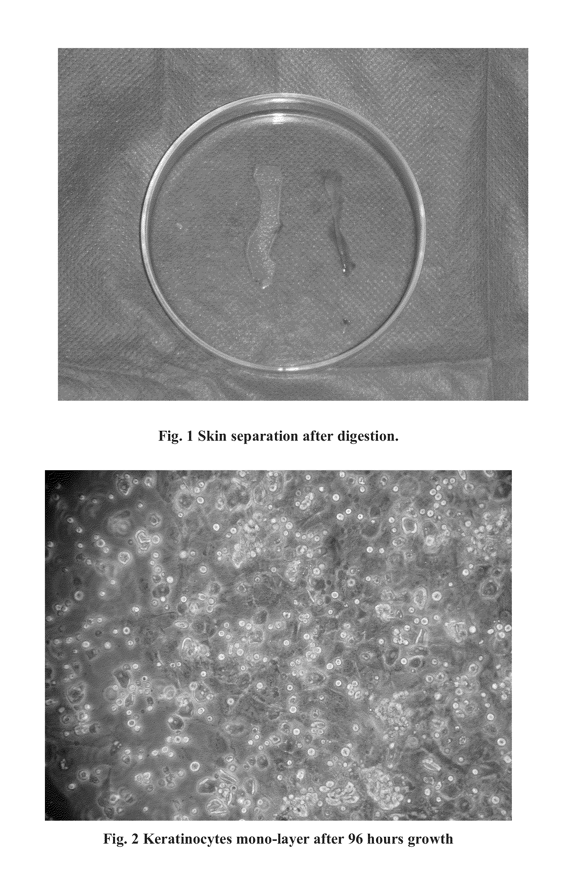 Process for the production of patches or derssings of autologous skin through cultivation of autologous keratinocytes and fibroblasts with autologous serum for the generation of skin