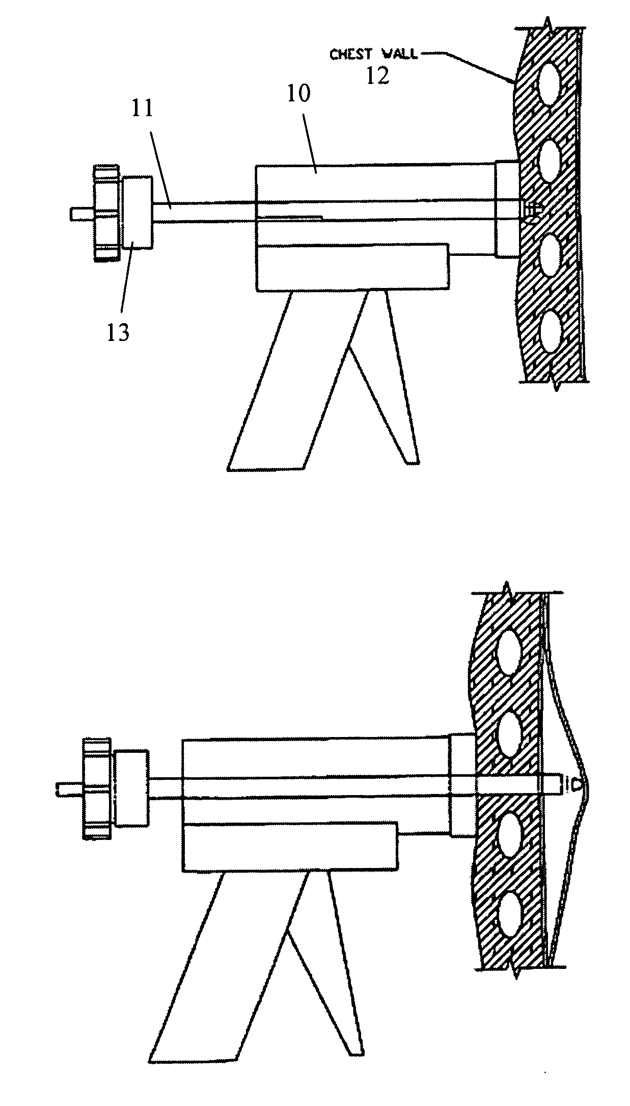 Apparatus and methods for safe and efficient placement of chest tubes