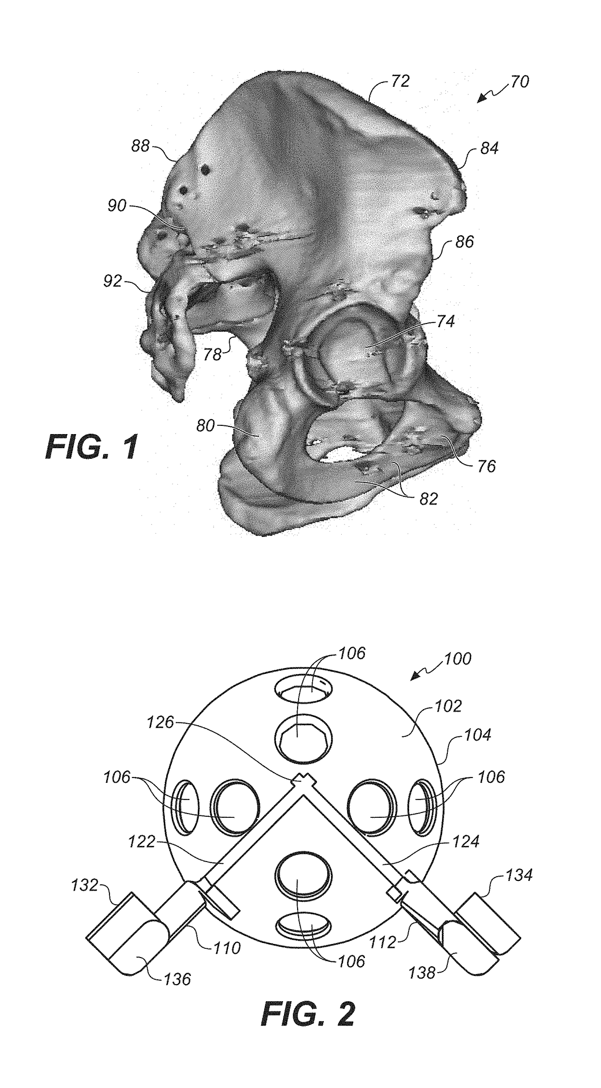 Bone cutting guide system for osteochondral transplantation