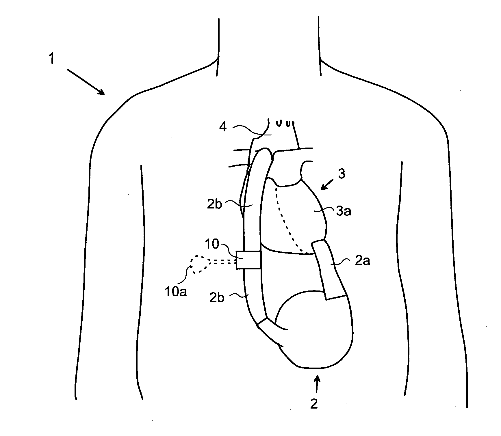 Blood clot removal device, system, and method