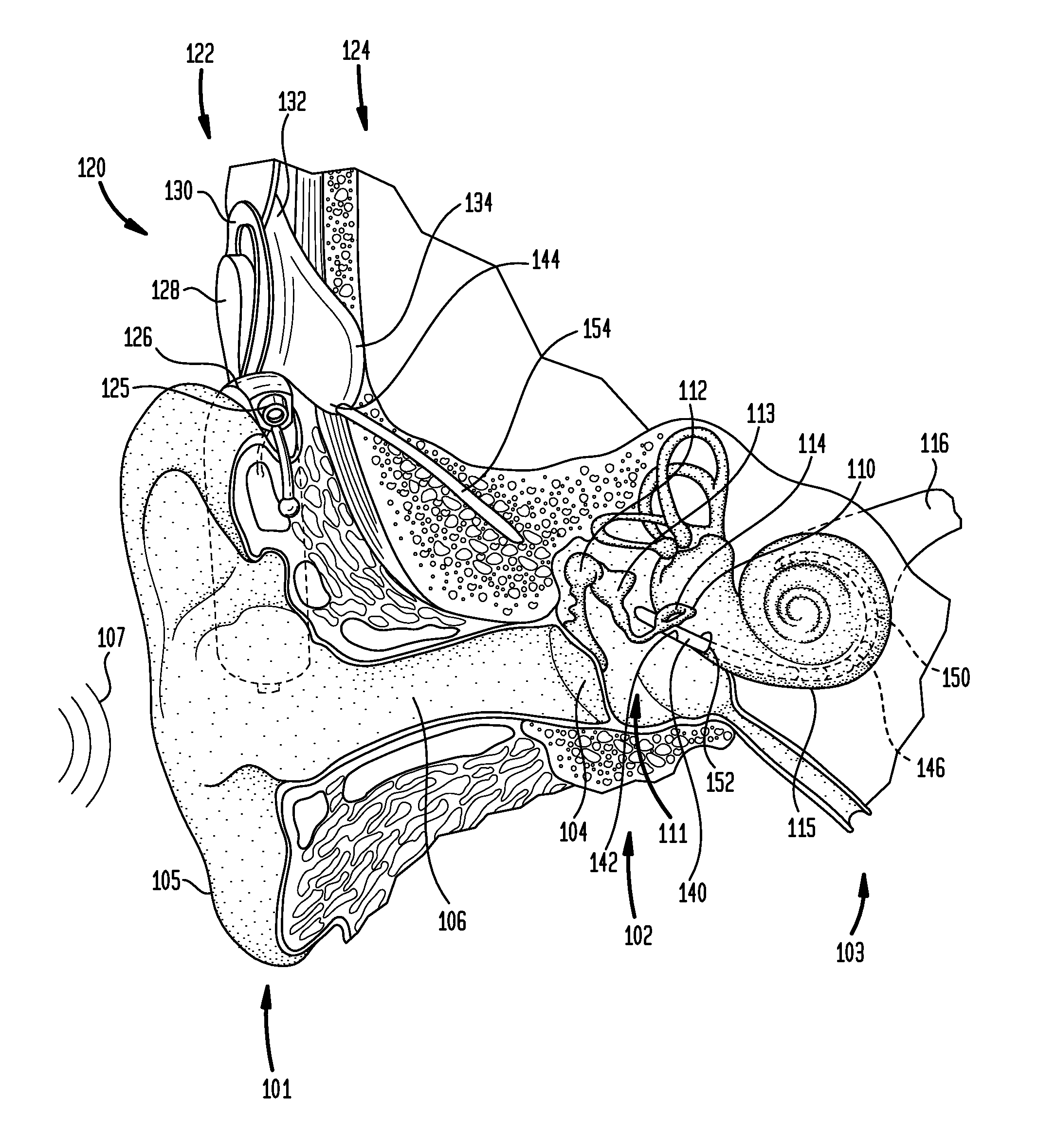 In situ adjustment of implantable components connected by an implantable electrical connector