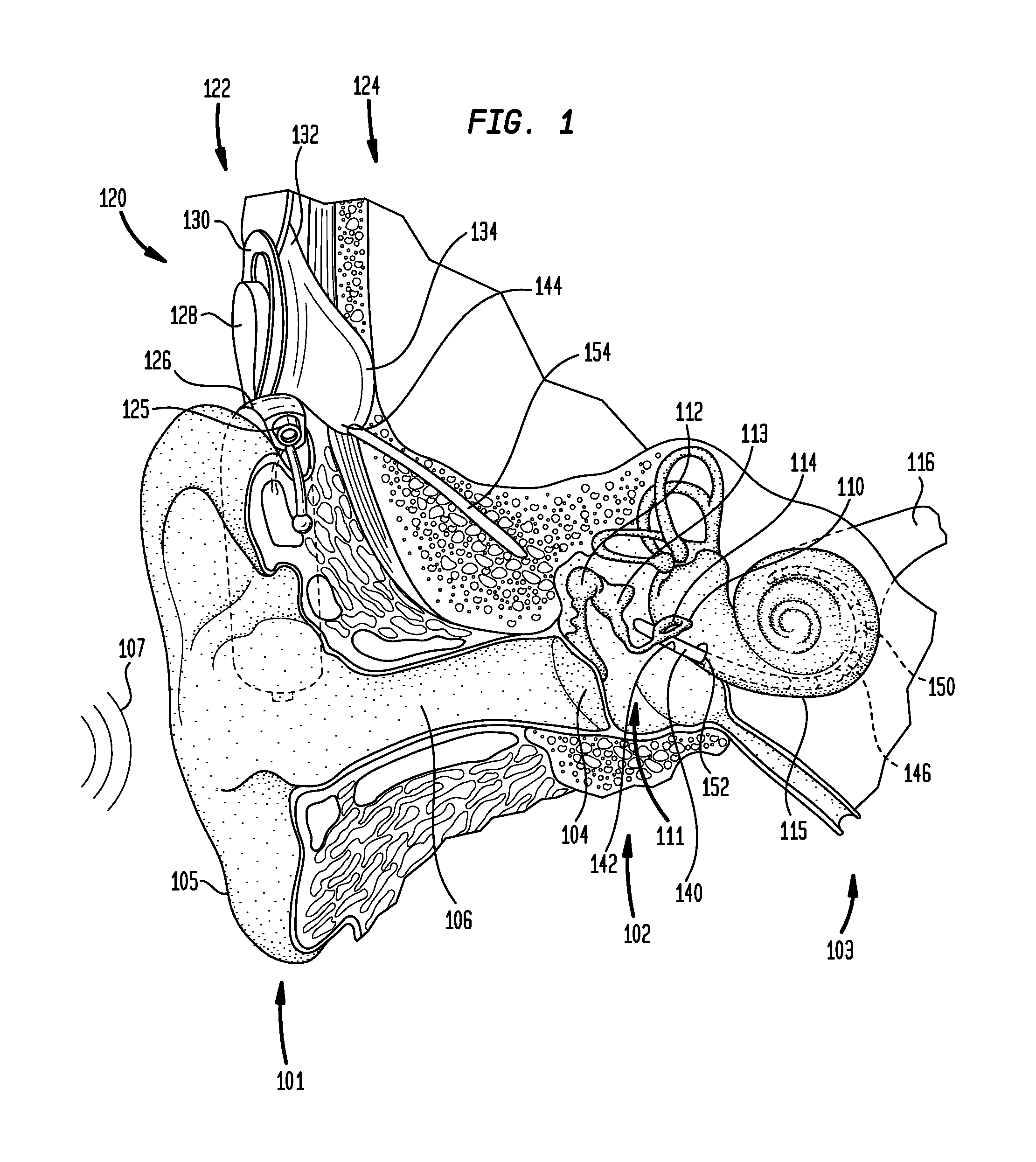 In situ adjustment of implantable components connected by an implantable electrical connector