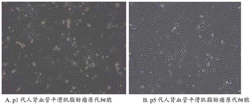 Human renal vascular smooth muscle lipoma primary cell, human renal vascular smooth muscle lipoma progeny cell and applications thereof