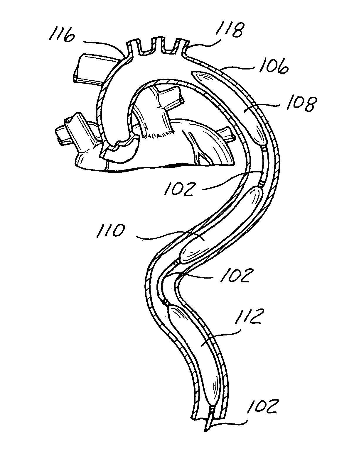 Long term ambulatory intra-aortic balloon pump with three dimensional tortuous shape