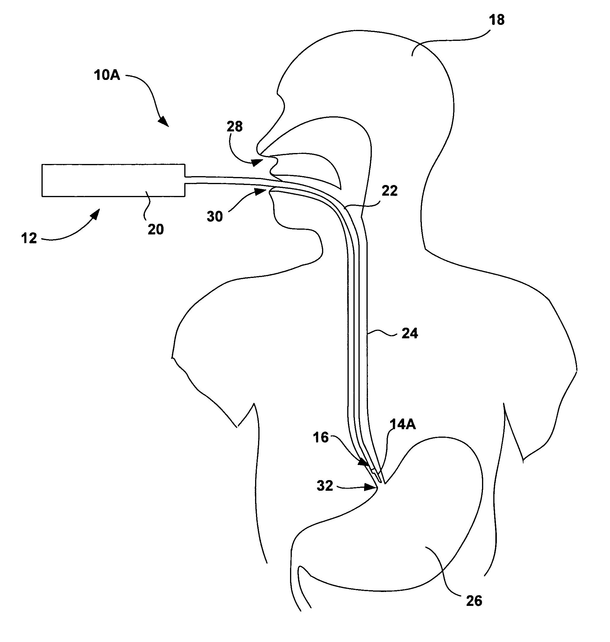 Distal portion of an endoscopic delivery system