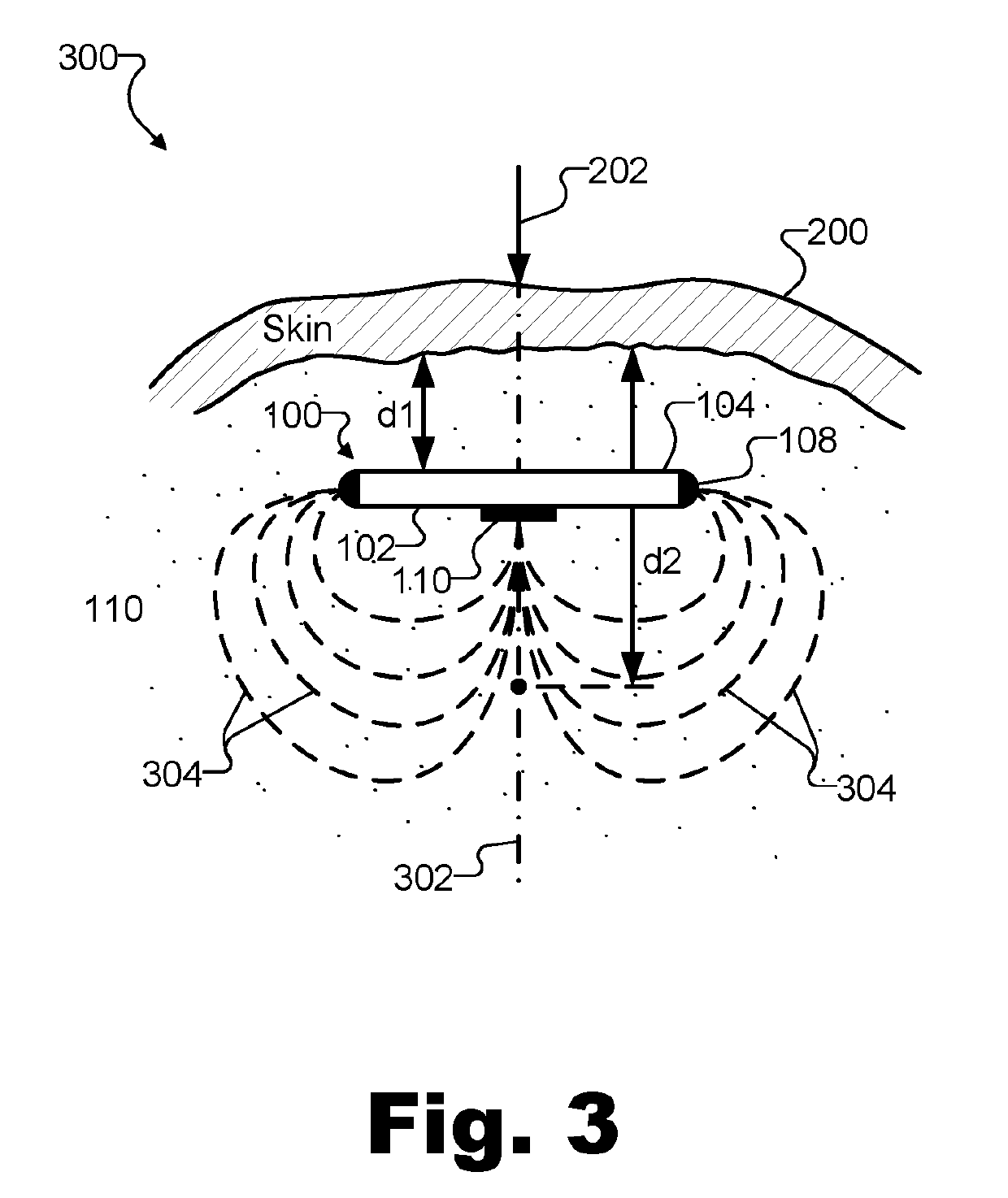 Methods and systems for treating osteoarthritis using an implantable electroacupuncture device
