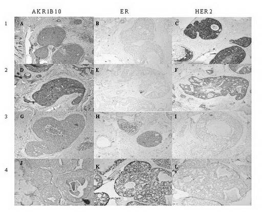 AKR1B10 (aldo-keto reductase family 1 B10) gene protein as breast cancer diagnostic marker and drug target