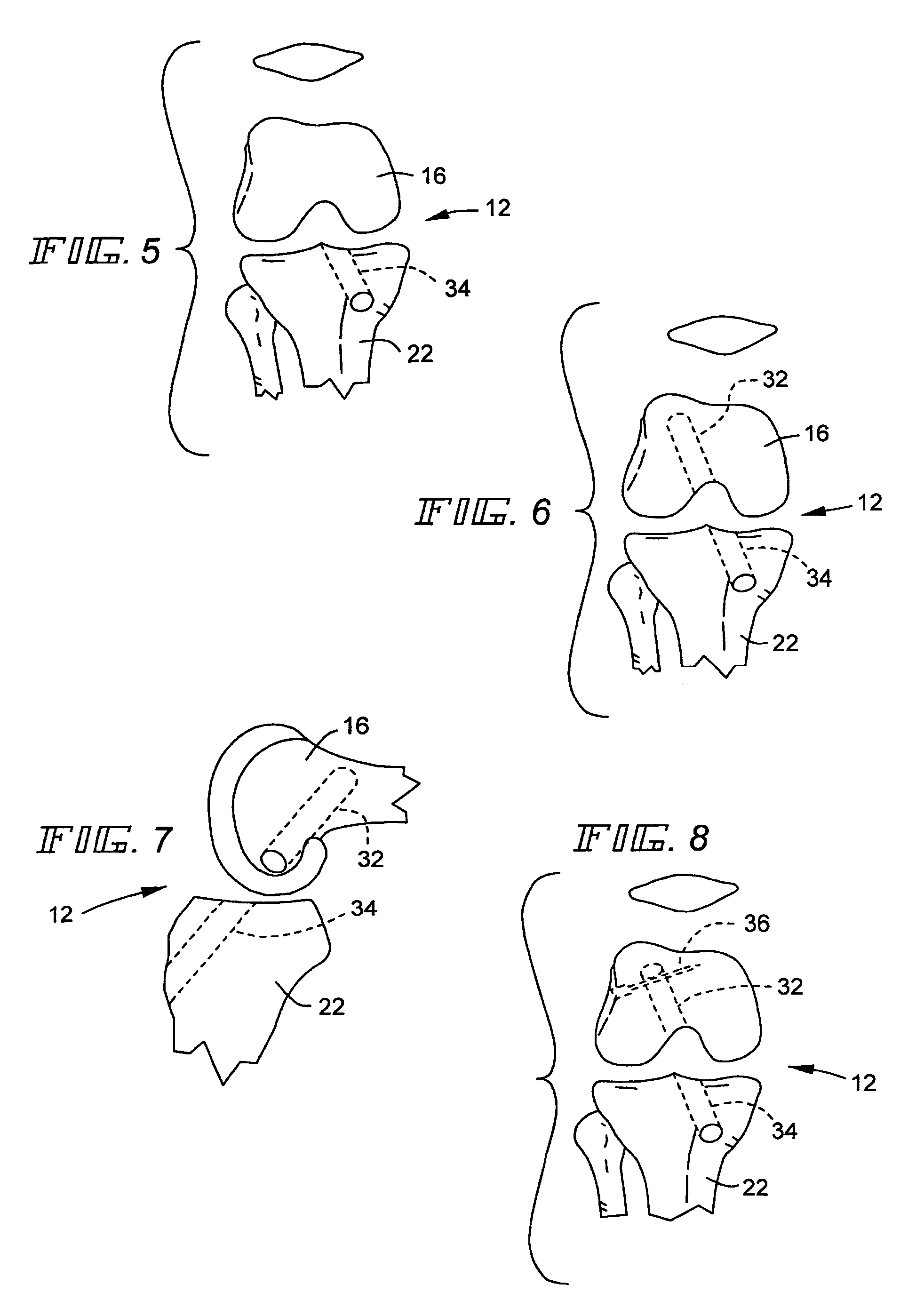 Method for reconstructing a knee