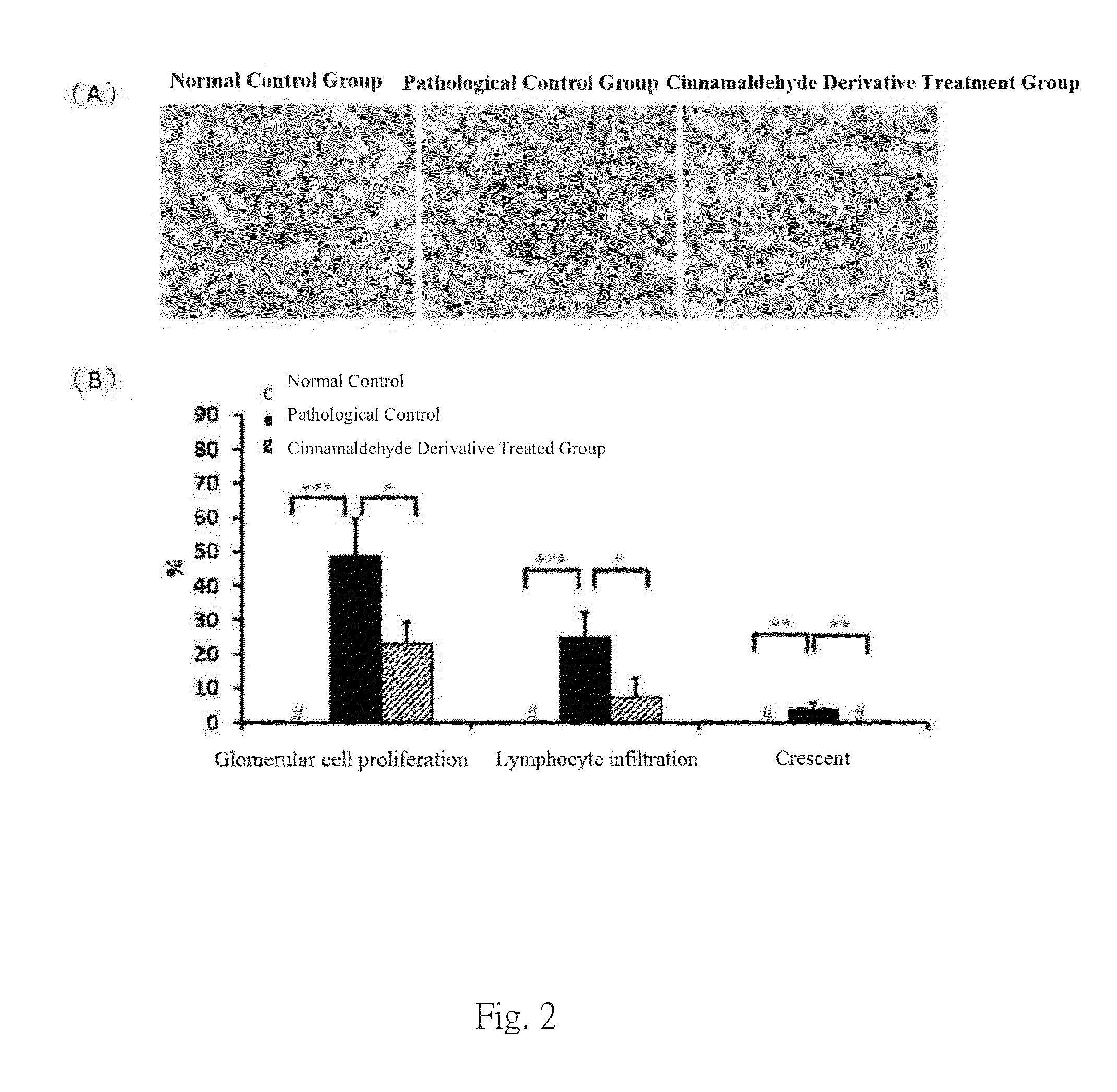 Use of hydroxycinnamaldehyde glycoside derivatives for treating glomerulonephritis