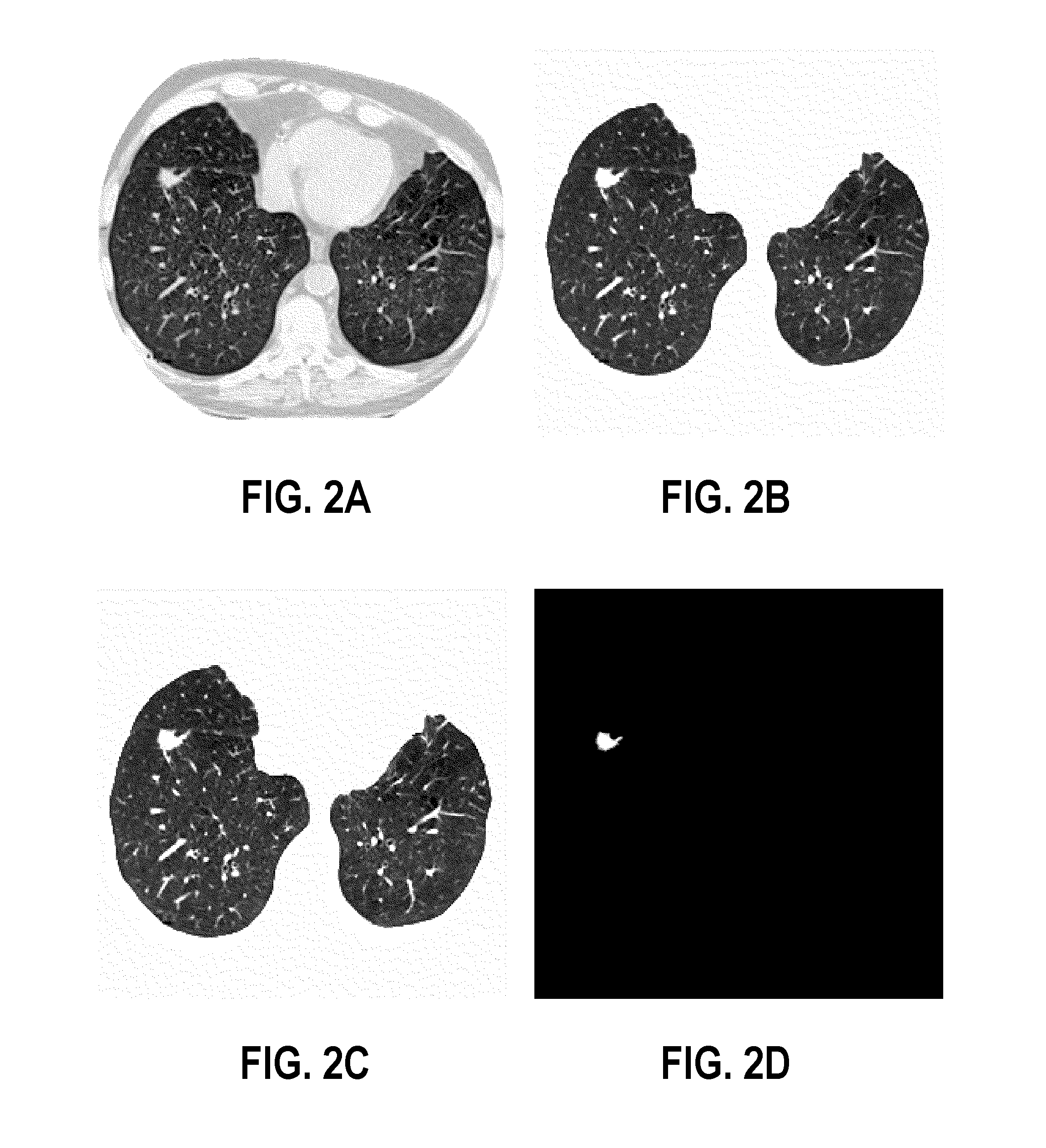 Computer aided diagnostic system incorporating shape analysis for diagnosing malignant lung nodules
