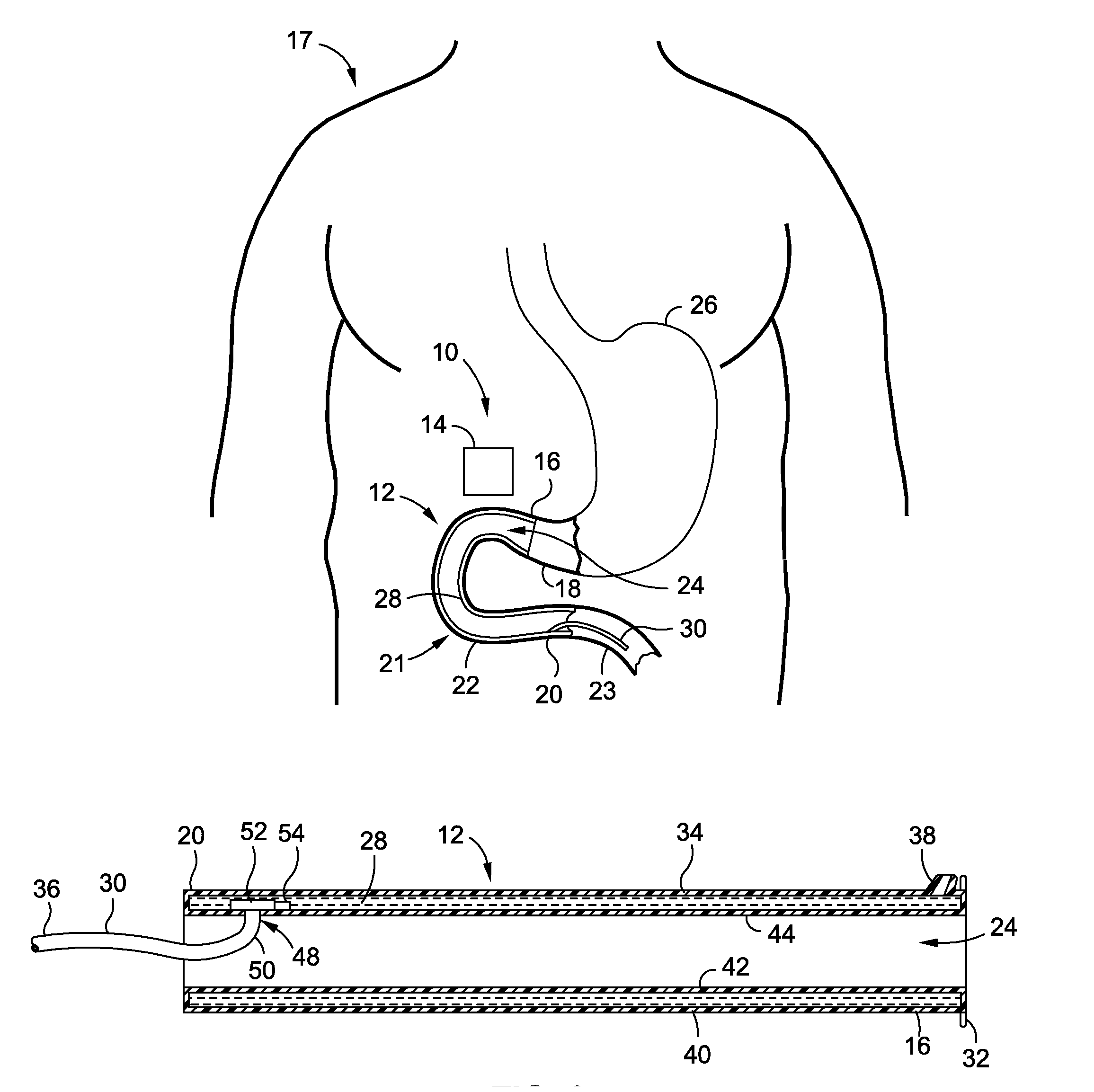 Intraluminal sleeve with active agents