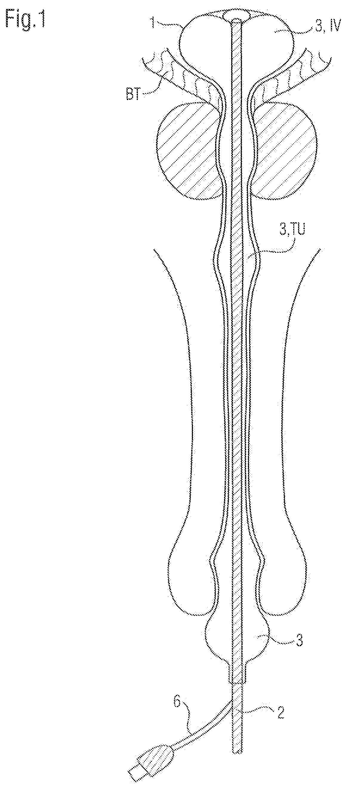 Bladder catheter for the minimally invasive discharge of urine