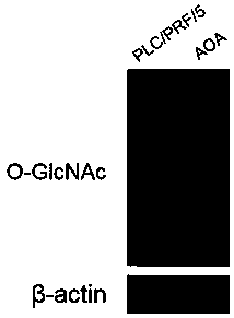 Application of aminooxyacetic acid to preparation of medicines for treating hepatocellular carcinoma