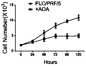 Application of aminooxyacetic acid to preparation of medicines for treating hepatocellular carcinoma