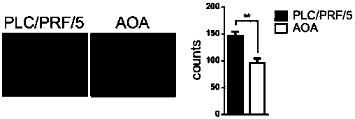 Application of aminooxyacetic acid to preparation of medicines for treating hepatocellular carcinoma