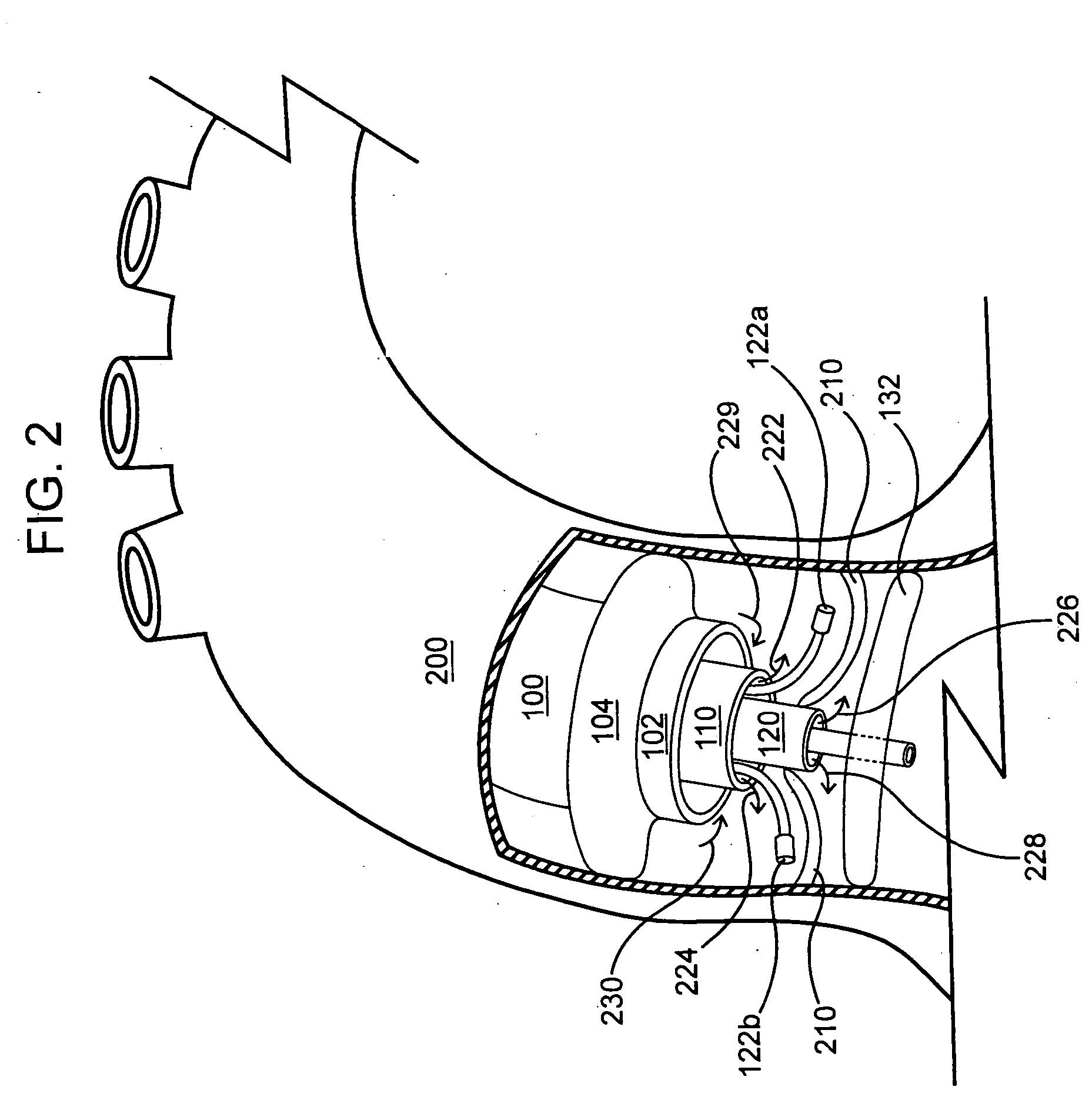 Devices and methods for treating aortic valve stenosis