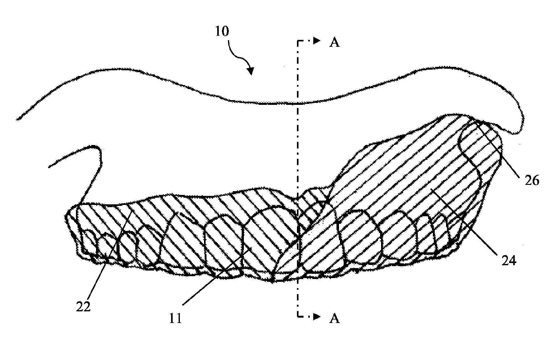 Intra-oral appliance and methods of using same
