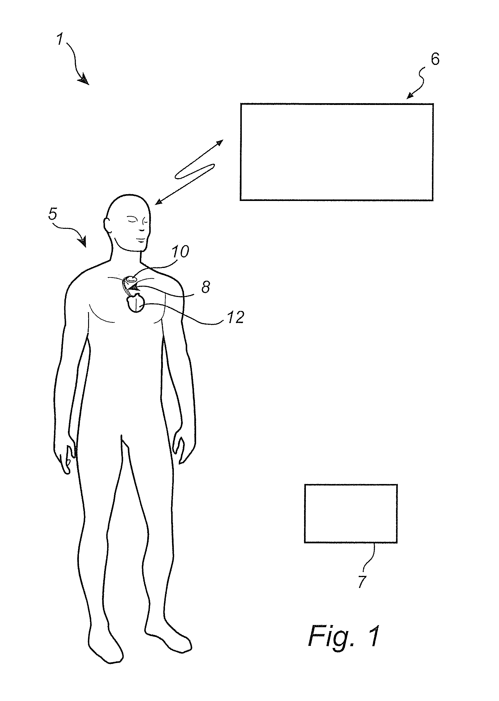 Method and system for adapting pacing settings of a cardiac stimulator