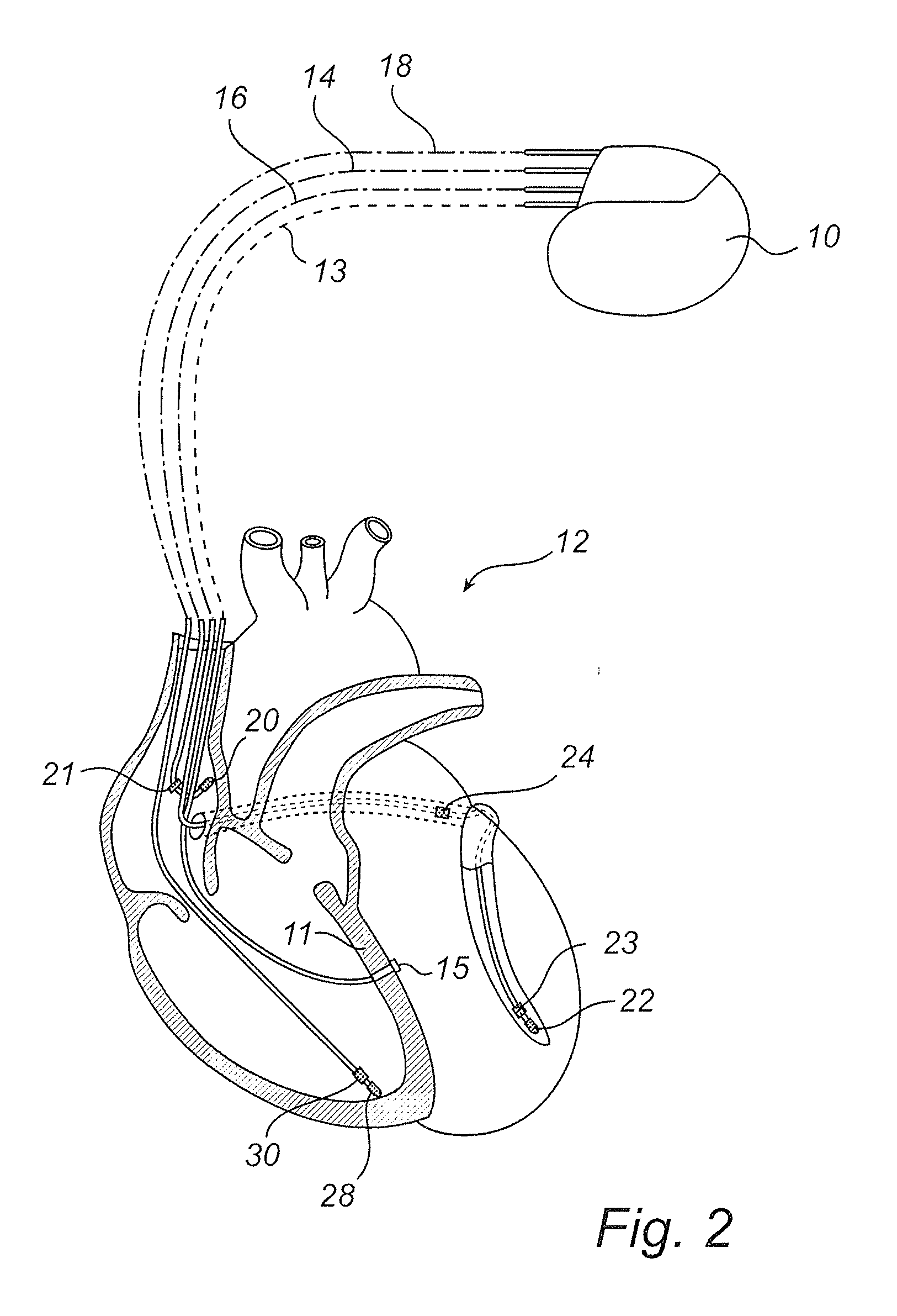 Method and system for adapting pacing settings of a cardiac stimulator