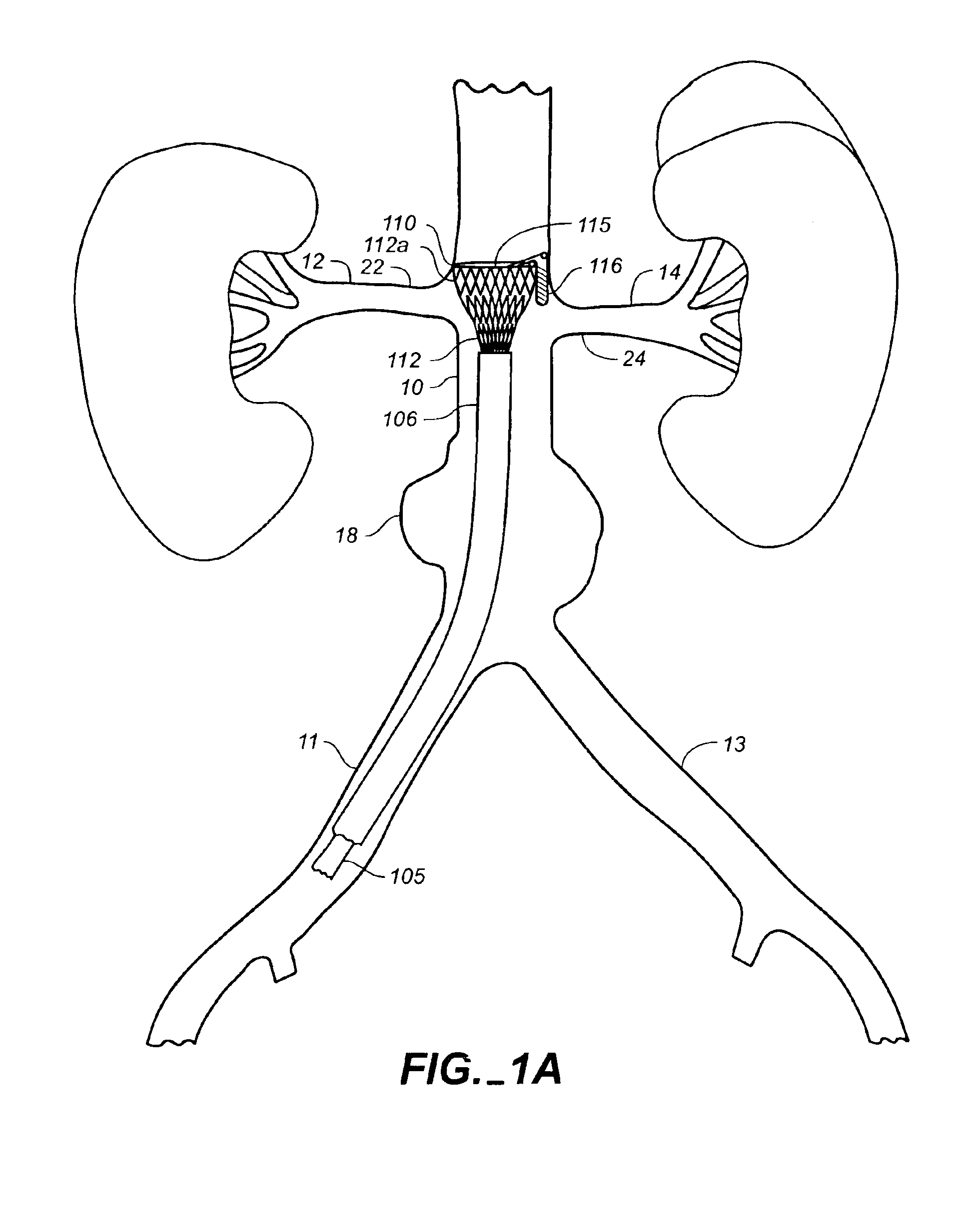 System for transrenal/intraostial fixation of endovascular prosthesis