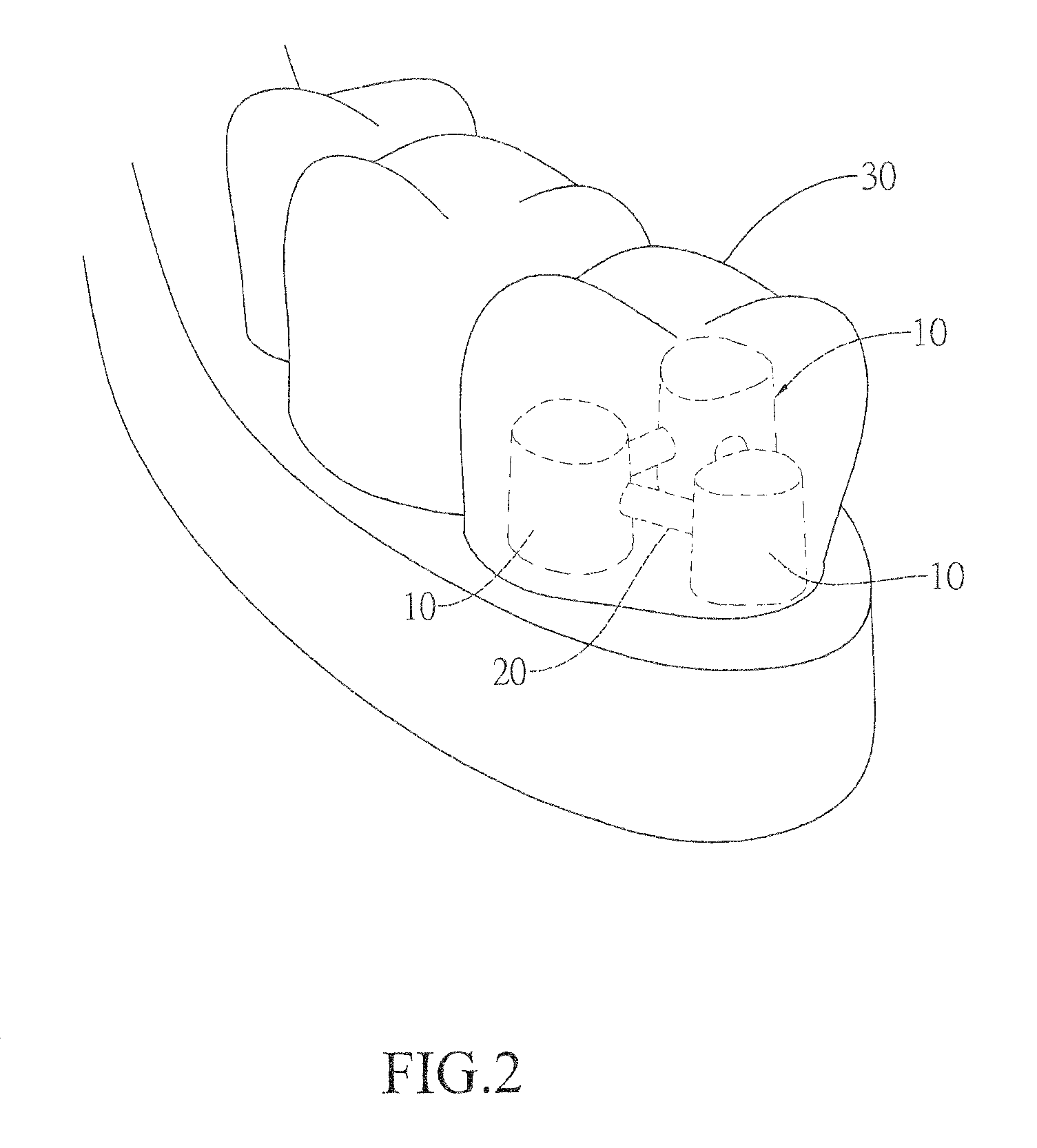 Artificial tooth with multiple internal crowns