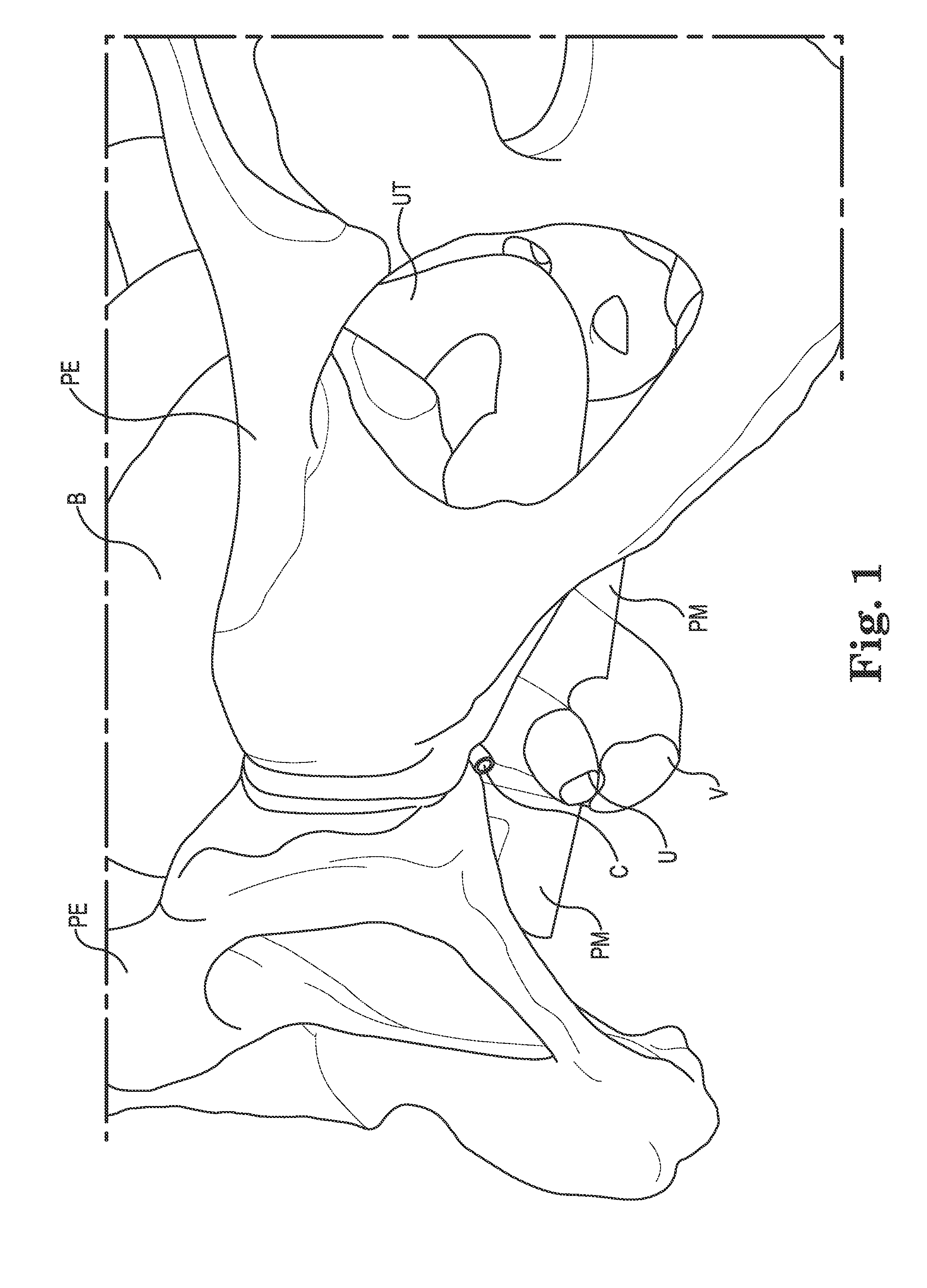 Surgical implant system and method
