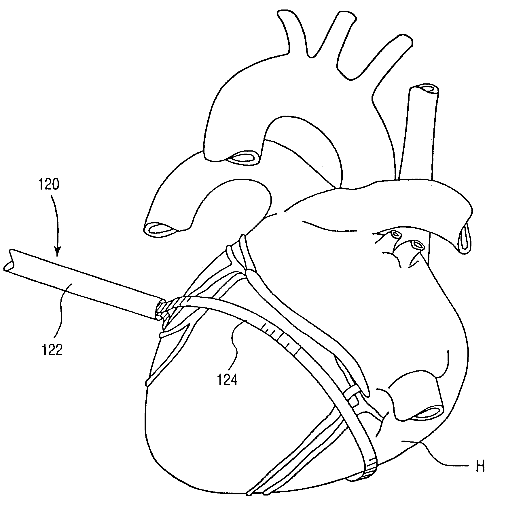 Minimally-invasive devices and methods for treatment of congestive heart failure