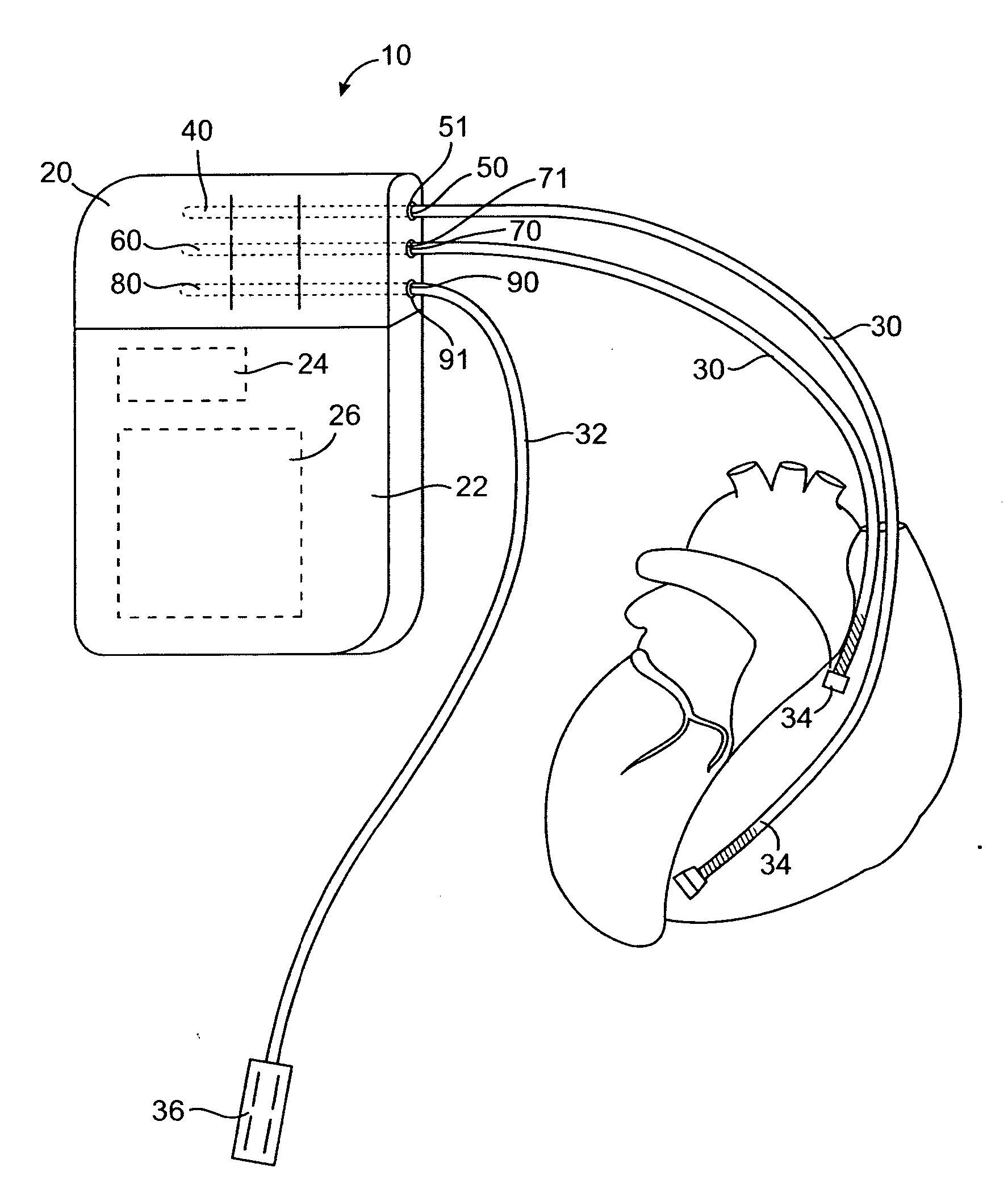Lockout connector arrangement for implantable medical device