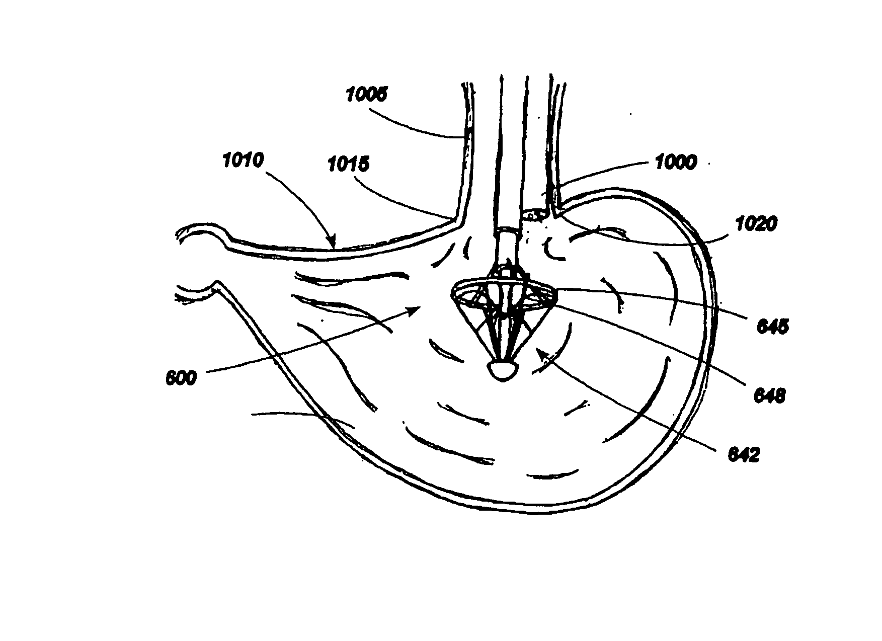 Implantable devices for controlling the size and shape of an anatomical structure or lumen