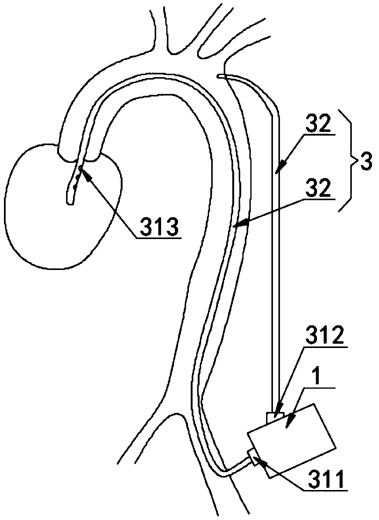 Left ventricular auxiliary device system