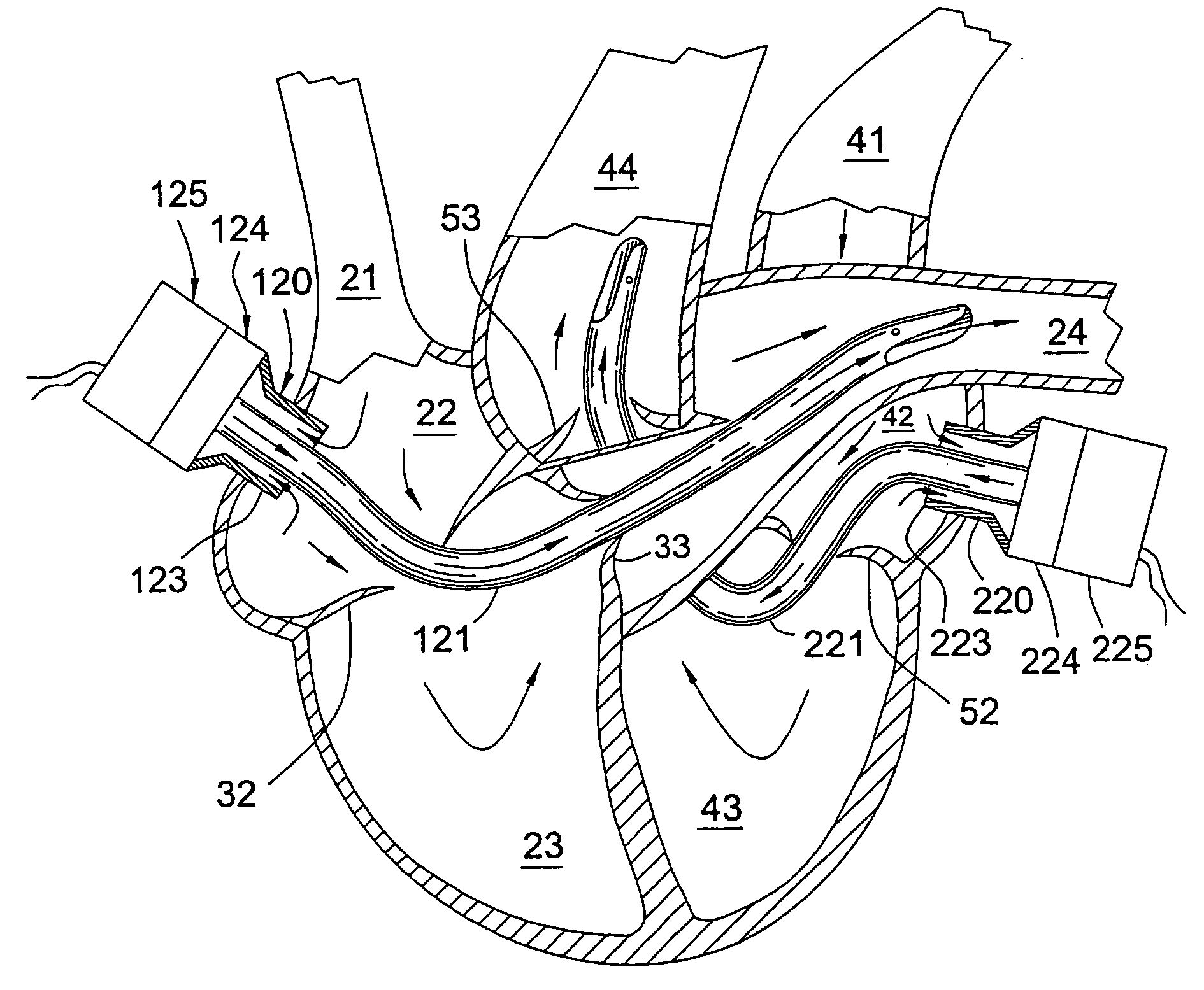 Pulmonary and circulatory blood flow support devices and methods for heart surgery procedures