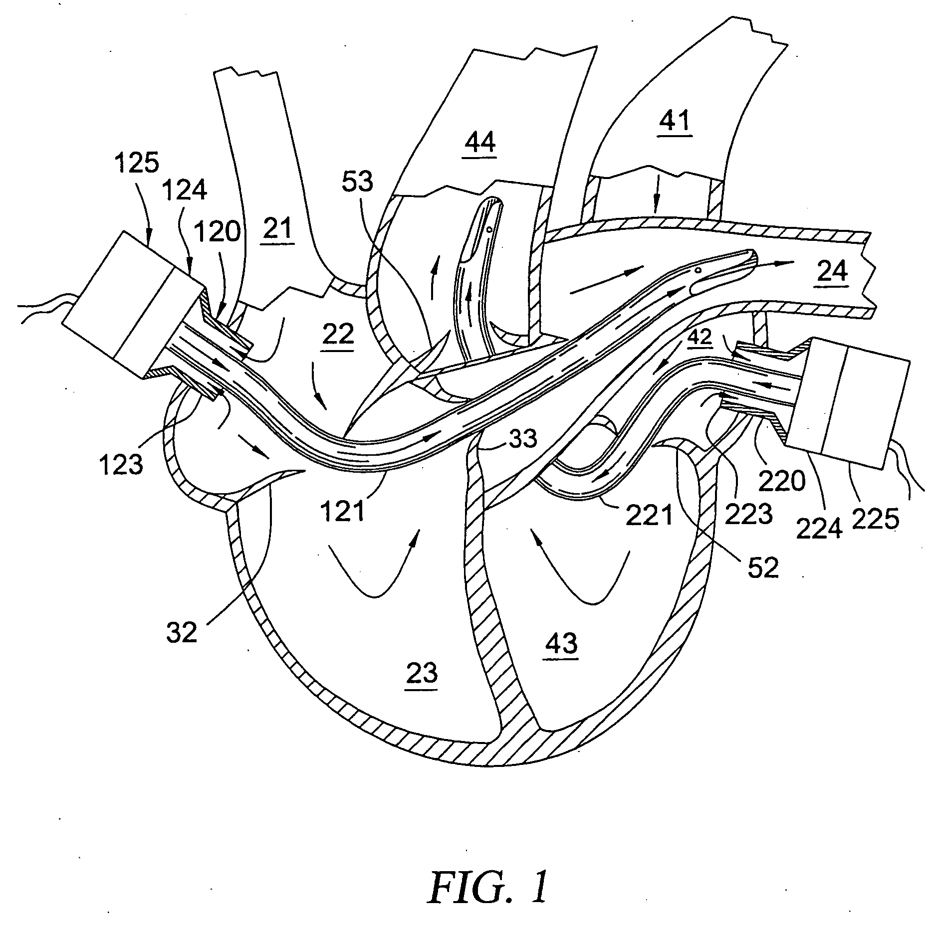 Pulmonary and circulatory blood flow support devices and methods for heart surgery procedures
