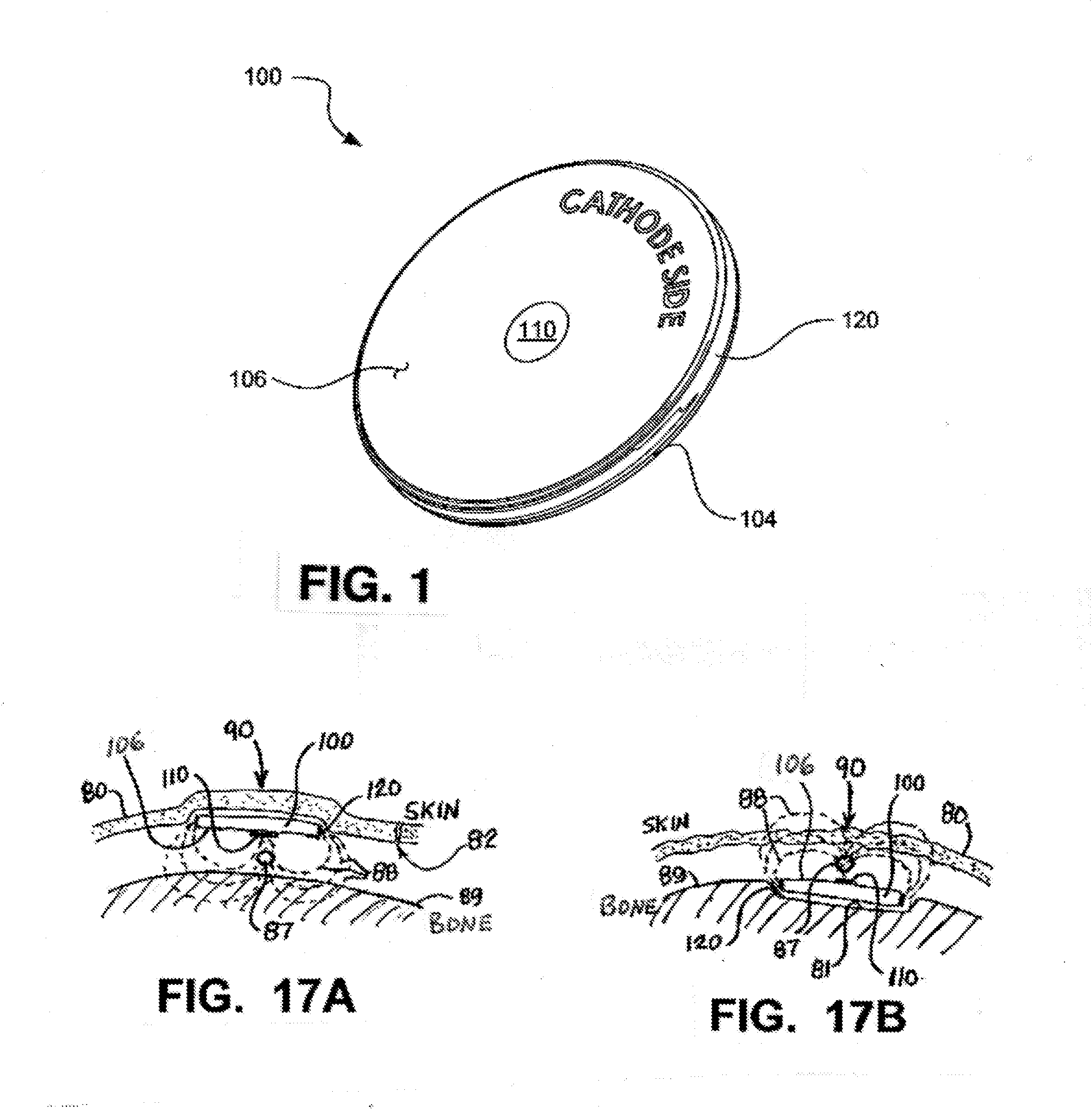 Implantable Electroacupuncture Device and Method
