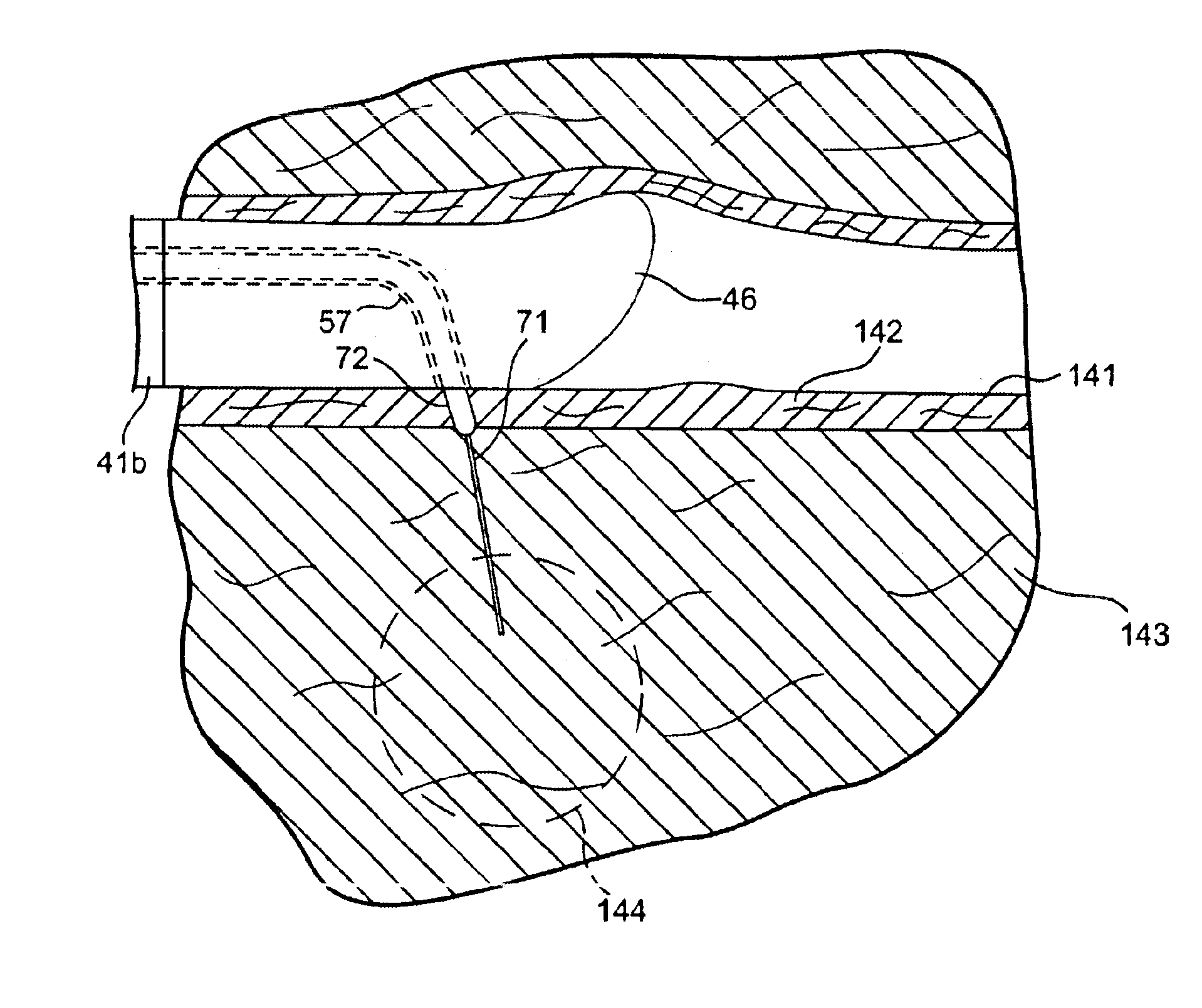 Method for treating tissue with a wet electrode and apparatus for using same