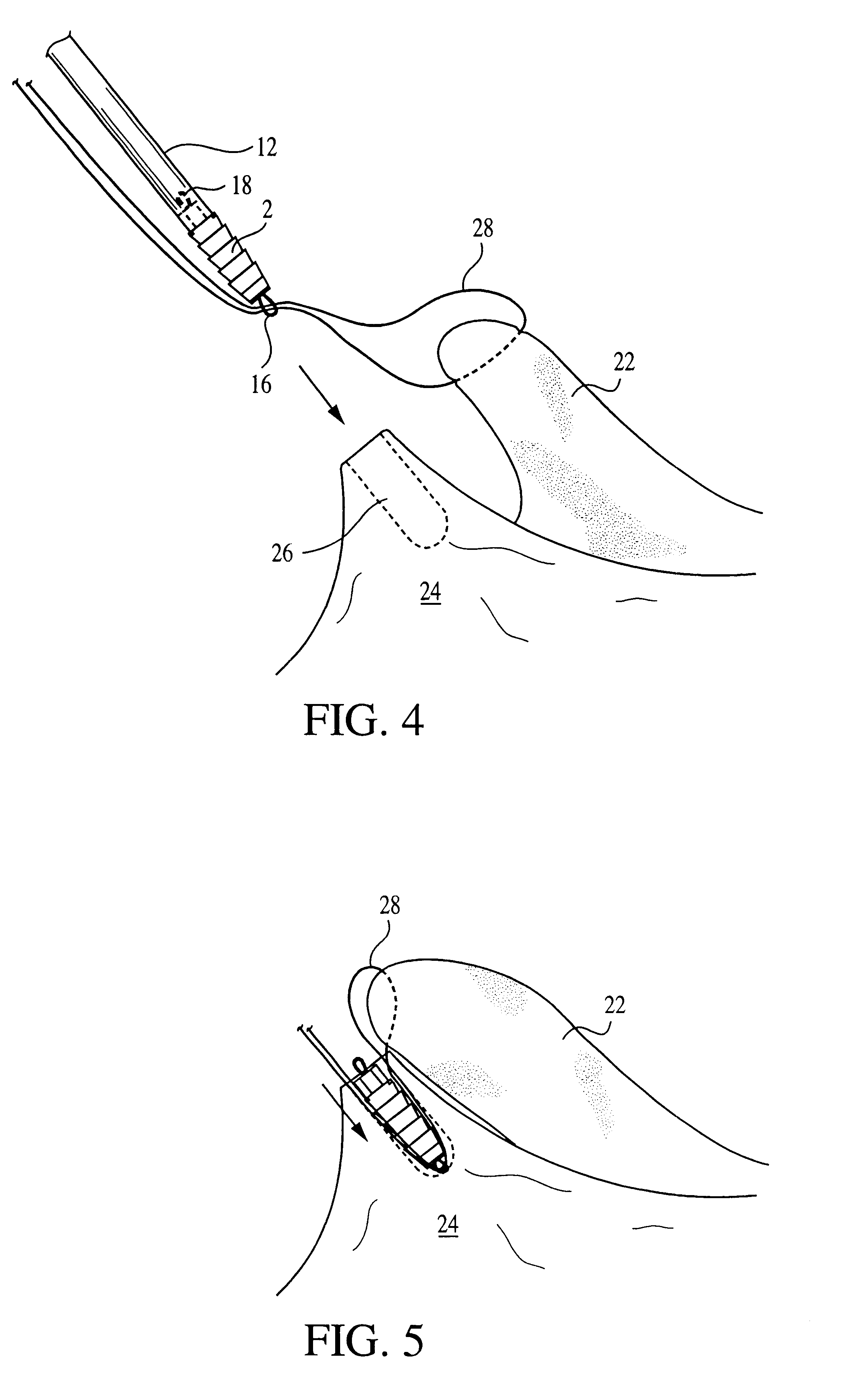 Interference fit knotless suture anchor fixation