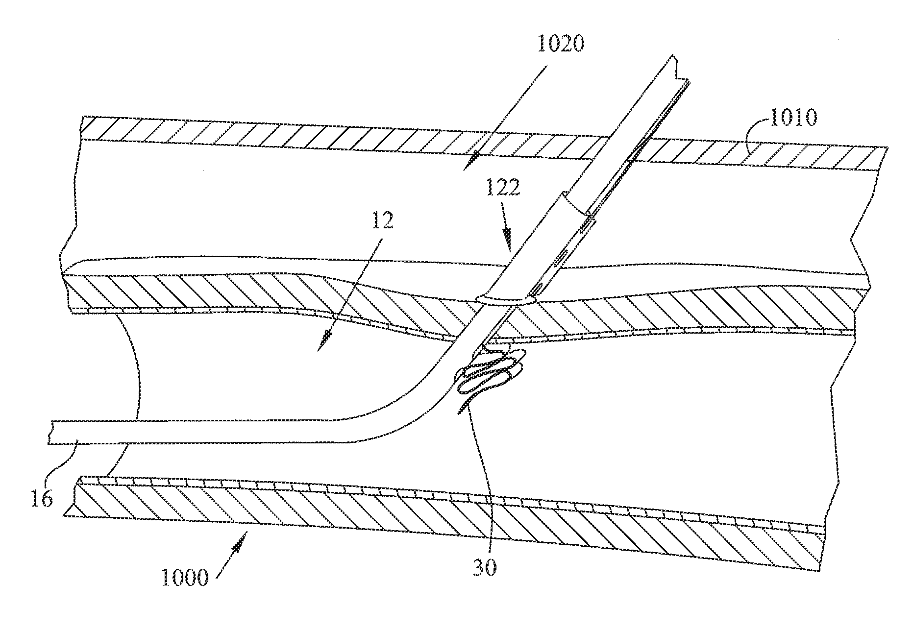 Method and apparatus for sealing access with an Anti-inflammatory infused member