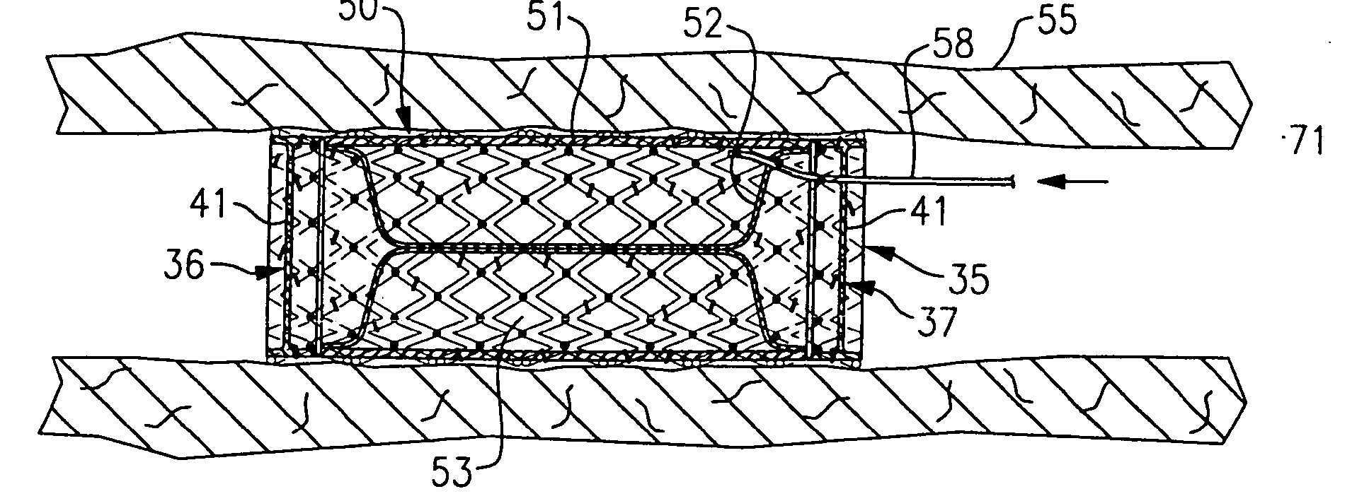 Apparatus for aiding the flow of blood through patient's circulatory system